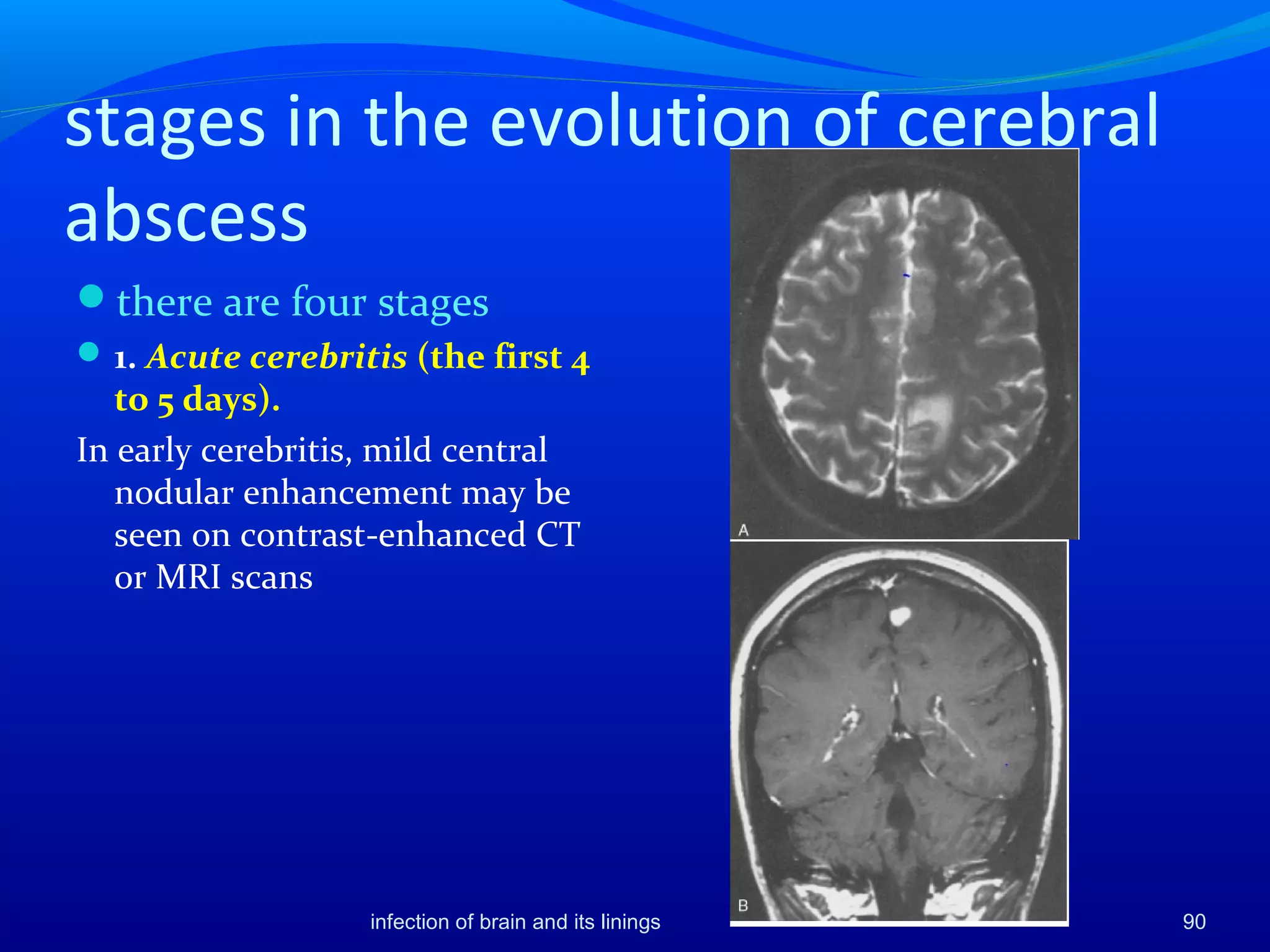 stages in the evolution of cerebral
abscess
there are four stages
1. Acute cerebritis (the first 4
to 5 days).
In early cerebritis, mild central
nodular enhancement may be
seen on contrast-enhanced CT
or MRI scans
infection of brain and its linings 90
 