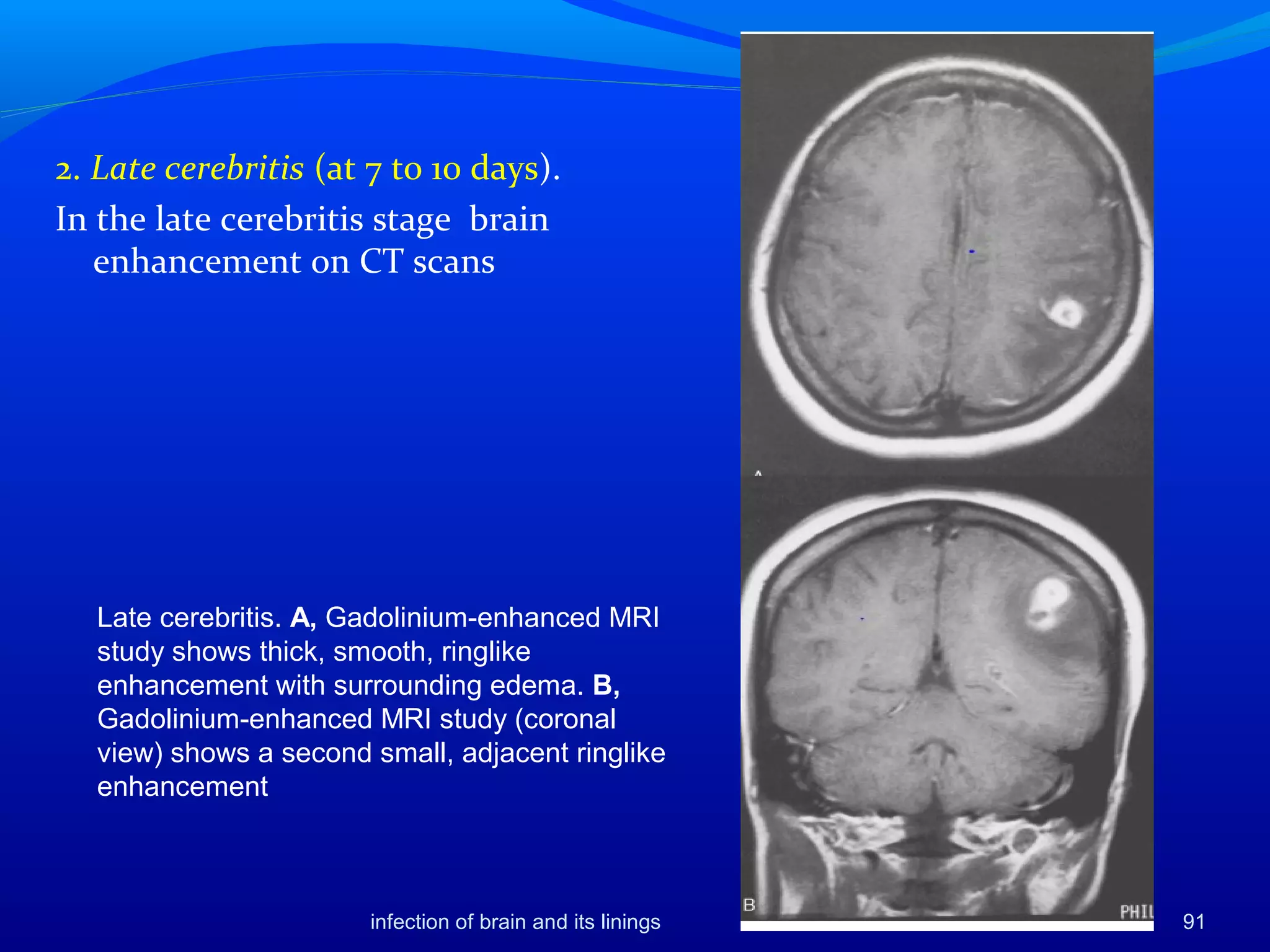 infection of brain and its linings 91
2. Late cerebritis (at 7 to 10 days).
In the late cerebritis stage brain
enhancement on CT scans
Late cerebritis. A, Gadolinium-enhanced MRI
study shows thick, smooth, ringlike
enhancement with surrounding edema. B,
Gadolinium-enhanced MRI study (coronal
view) shows a second small, adjacent ringlike
enhancement
 