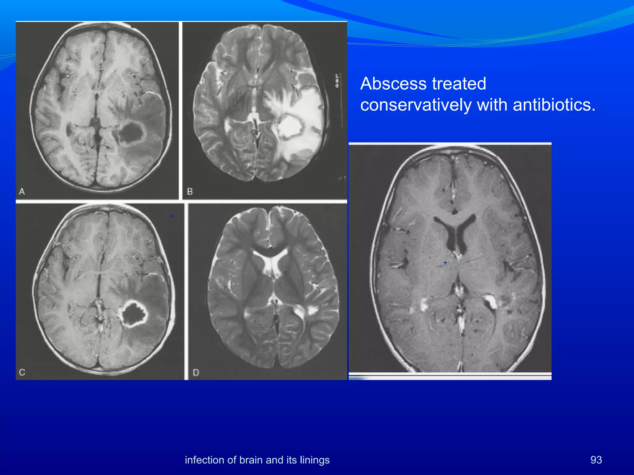 infection of brain and its linings 93
Abscess treated
conservatively with antibiotics.
 