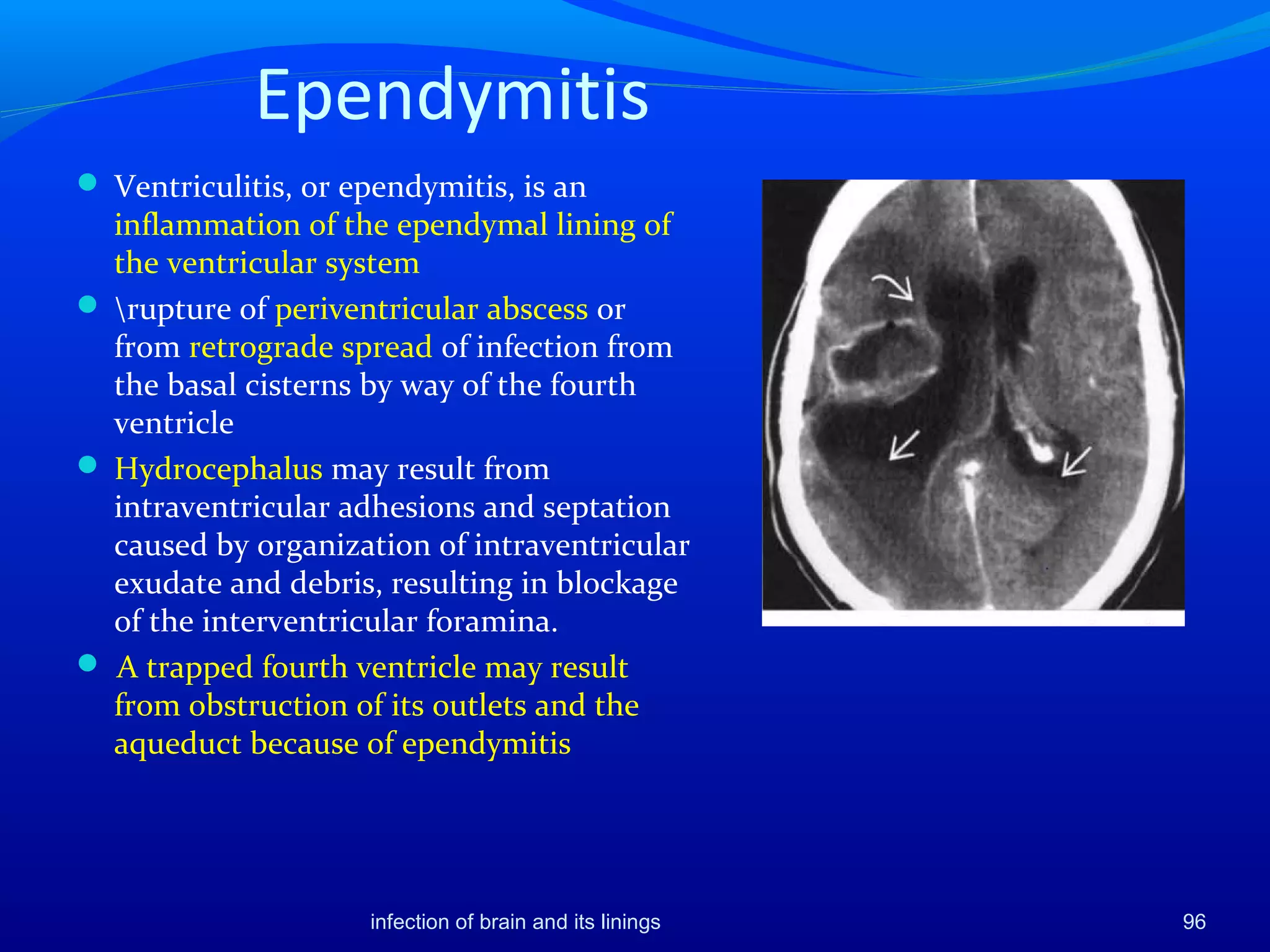 Ependymitis
 Ventriculitis, or ependymitis, is an
inflammation of the ependymal lining of
the ventricular system
 rupture of periventricular abscess or
from retrograde spread of infection from
the basal cisterns by way of the fourth
ventricle
 Hydrocephalus may result from
intraventricular adhesions and septation
caused by organization of intraventricular
exudate and debris, resulting in blockage
of the interventricular foramina.
 A trapped fourth ventricle may result
from obstruction of its outlets and the
aqueduct because of ependymitis
infection of brain and its linings 96
 