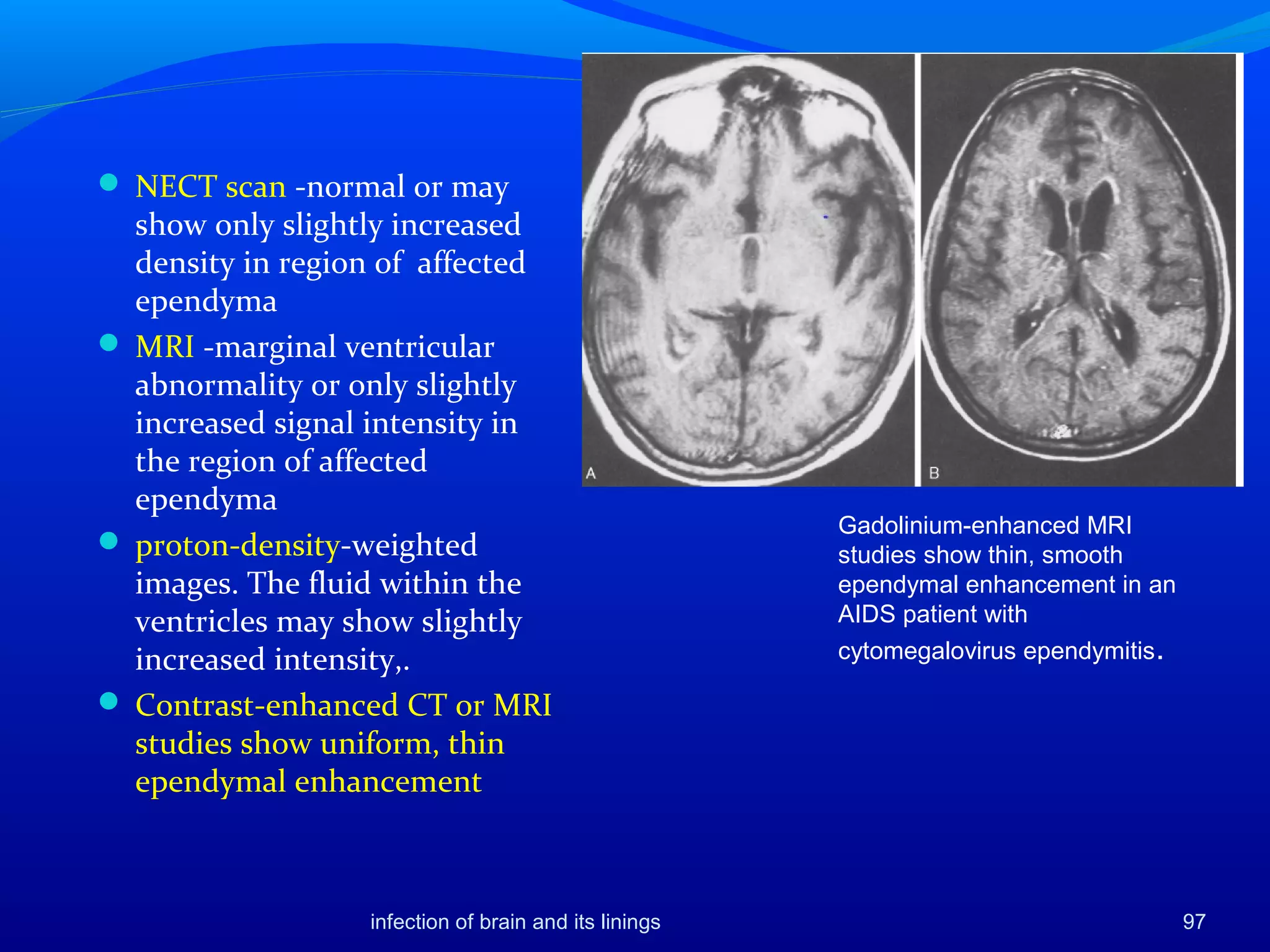 infection of brain and its linings 97
 NECT scan -normal or may
show only slightly increased
density in region of affected
ependyma
 MRI -marginal ventricular
abnormality or only slightly
increased signal intensity in
the region of affected
ependyma
 proton-density-weighted
images. The fluid within the
ventricles may show slightly
increased intensity,.
 Contrast-enhanced CT or MRI
studies show uniform, thin
ependymal enhancement
Gadolinium-enhanced MRI
studies show thin, smooth
ependymal enhancement in an
AIDS patient with
cytomegalovirus ependymitis.
 