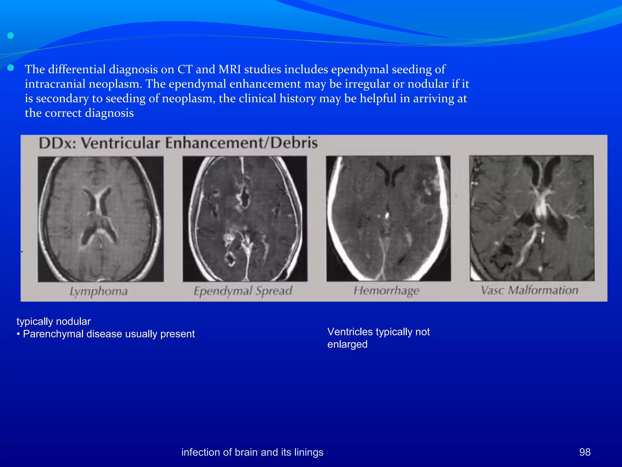 
 The differential diagnosis on CT and MRI studies includes ependymal seeding of
intracranial neoplasm. The ependymal enhancement may be irregular or nodular if it
is secondary to seeding of neoplasm, the clinical history may be helpful in arriving at
the correct diagnosis
typically nodular
• Parenchymal disease usually present Ventricles typically not
enlarged
98infection of brain and its linings
 