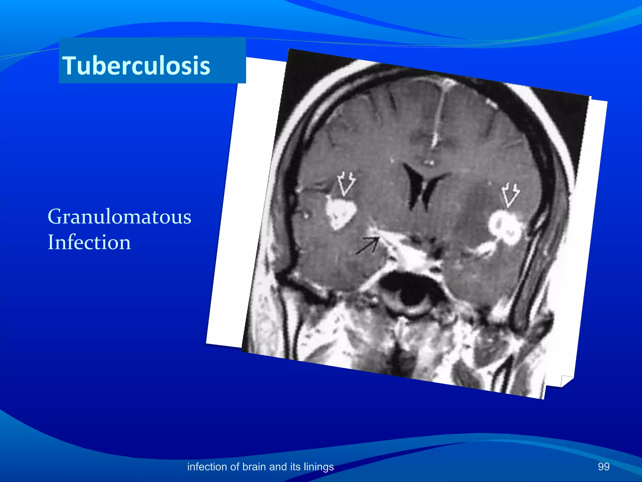 Granulomatous
Infection
99
Tuberculosis
infection of brain and its linings
 