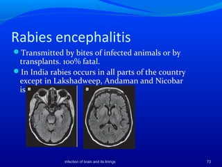 Imaging of infection of brain and its linings | PPT