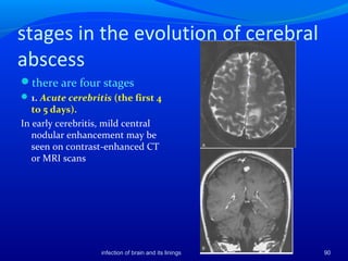 Imaging of infection of brain and its linings | PPT