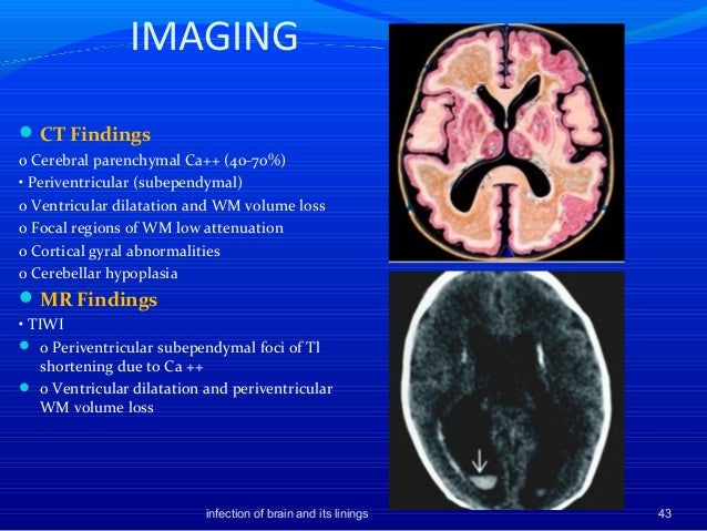 Imaging of infection of brain and its linings mri zones diagram 