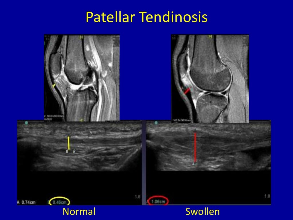 Imaging of knee by mr and usg