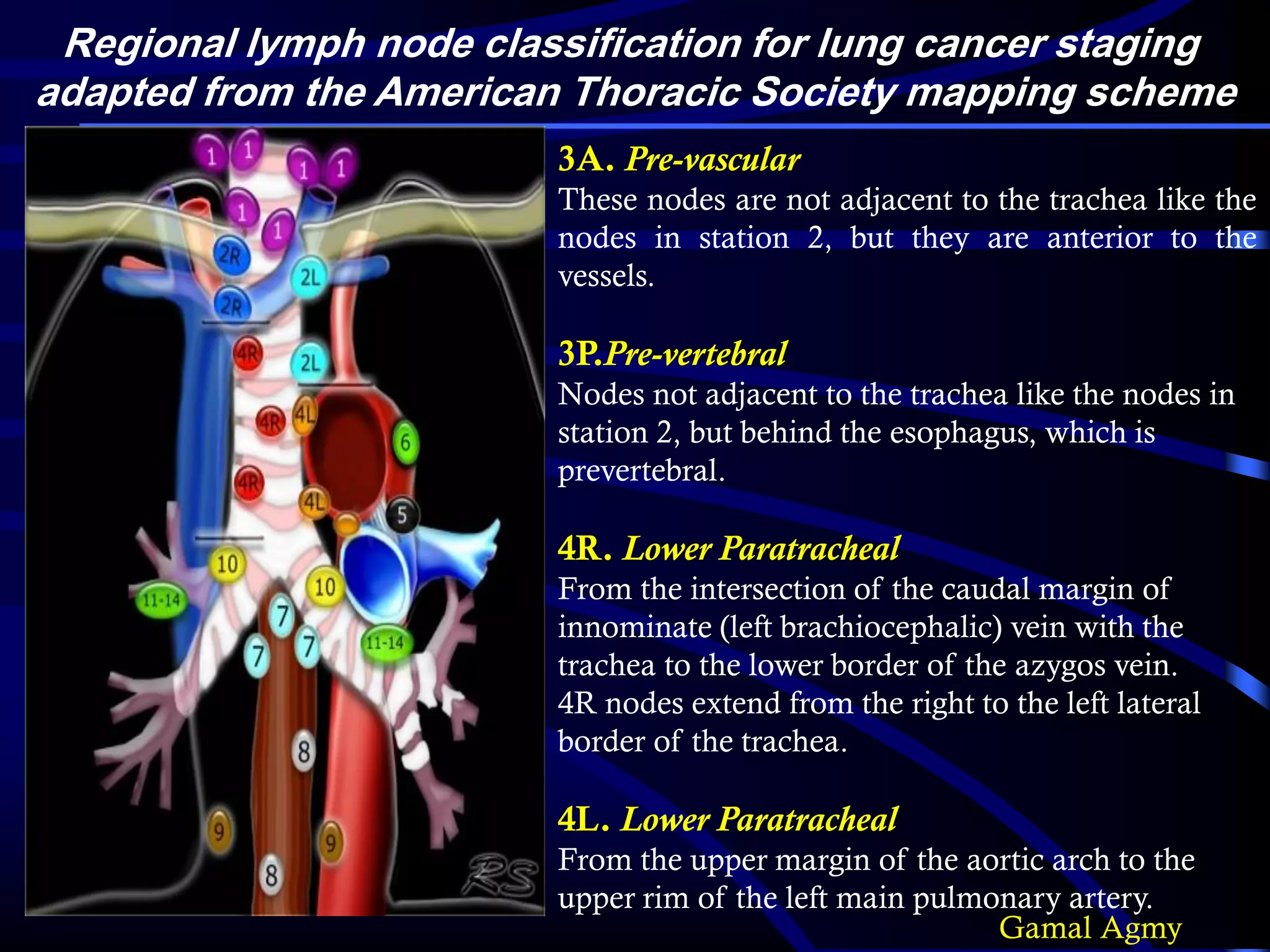 •
Regional lymph node classification for lung cancer staging
adapted from the American Thoracic Society mapping scheme
3A. Pre-vascular
These nodes are not adjacent to the trachea like the
nodes in station 2, but they are anterior to the
vessels.
3P.Pre-vertebral
Nodes not adjacent to the trachea like the nodes in
station 2, but behind the esophagus, which is
prevertebral.
4R. Lower Paratracheal
From the intersection of the caudal margin of
innominate (left brachiocephalic) vein with the
trachea to the lower border of the azygos vein.
4R nodes extend from the right to the left lateral
border of the trachea.
4L. Lower Paratracheal
From the upper margin of the aortic arch to the
upper rim of the left main pulmonary artery.
Gamal Agmy
 