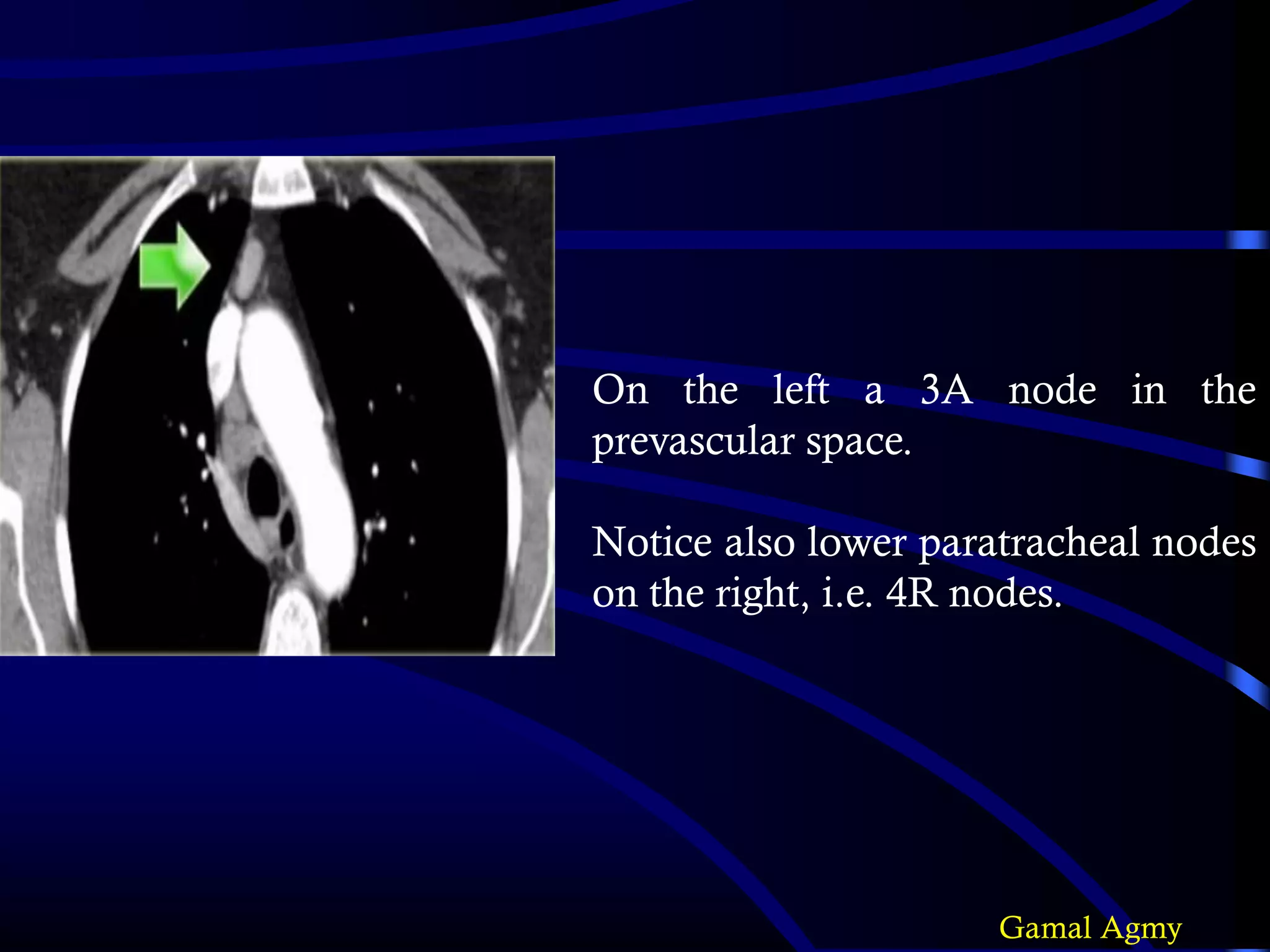 On the left a 3A node in the
prevascular space.
Notice also lower paratracheal nodes
on the right, i.e. 4R nodes.
Gamal Agmy
 