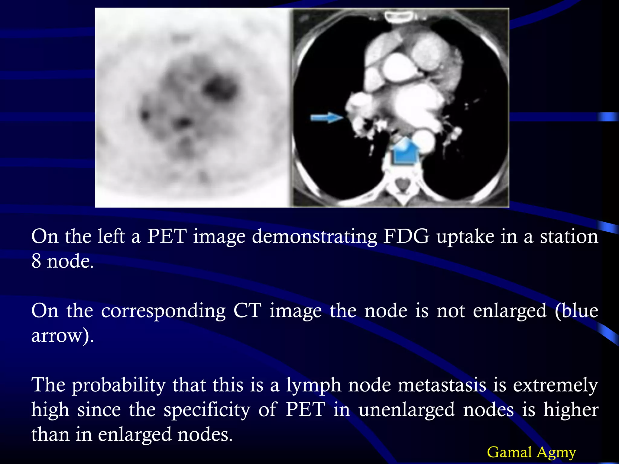 On the left a PET image demonstrating FDG uptake in a station
8 node.
On the corresponding CT image the node is not enlarged (blue
arrow).
The probability that this is a lymph node metastasis is extremely
high since the specificity of PET in unenlarged nodes is higher
than in enlarged nodes.
Gamal Agmy
 