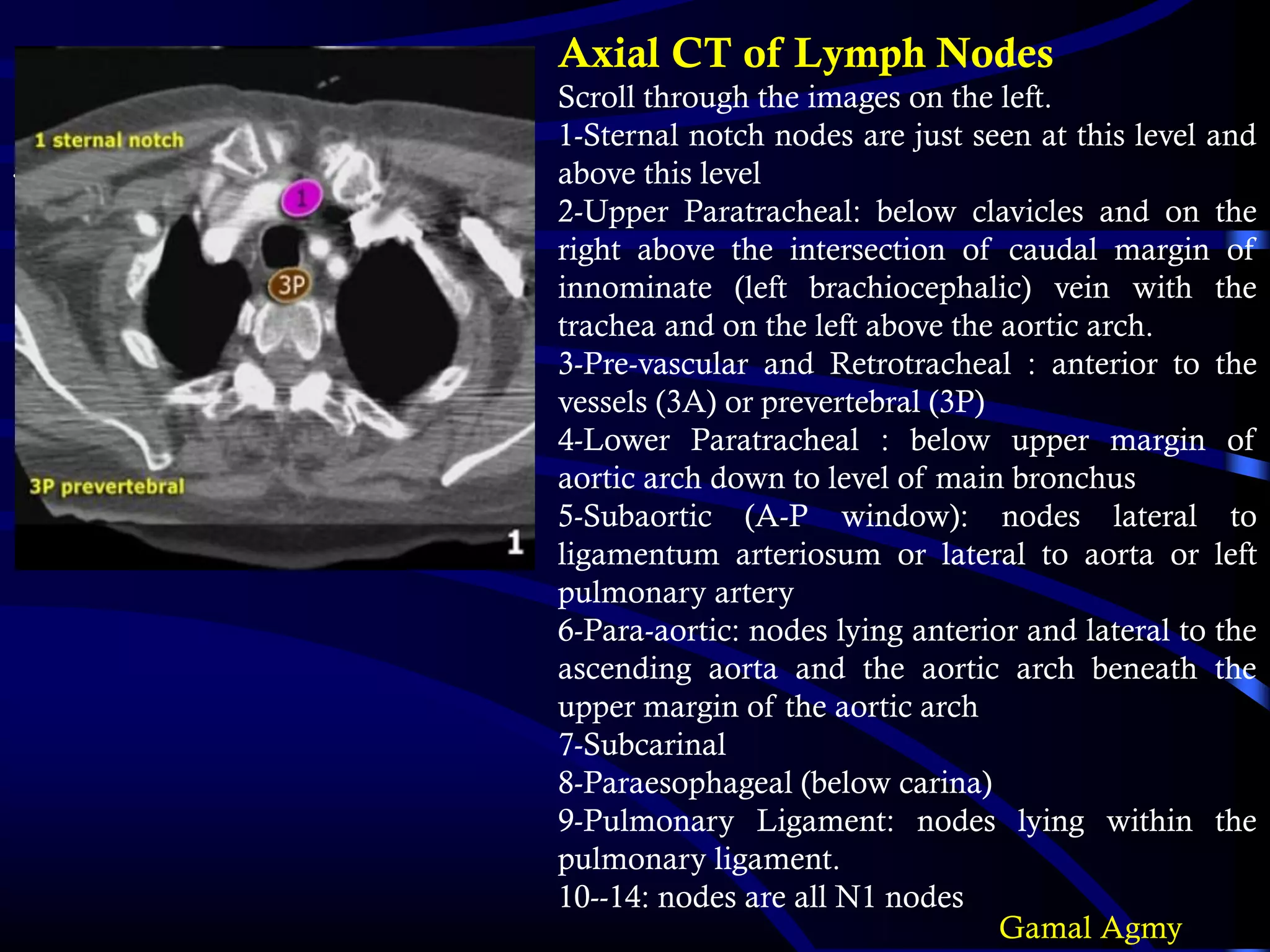 Axial CT of Lymph Nodes
Scroll through the images on the left.
1-Sternal notch nodes are just seen at this level and
above this level
2-Upper Paratracheal: below clavicles and on the
right above the intersection of caudal margin of
innominate (left brachiocephalic) vein with the
trachea and on the left above the aortic arch.
3-Pre-vascular and Retrotracheal : anterior to the
vessels (3A) or prevertebral (3P)
4-Lower Paratracheal : below upper margin of
aortic arch down to level of main bronchus
5-Subaortic (A-P window): nodes lateral to
ligamentum arteriosum or lateral to aorta or left
pulmonary artery
6-Para-aortic: nodes lying anterior and lateral to the
ascending aorta and the aortic arch beneath the
upper margin of the aortic arch
7-Subcarinal
8-Paraesophageal (below carina)
9-Pulmonary Ligament: nodes lying within the
pulmonary ligament.
10--14: nodes are all N1 nodes
•
Gamal Agmy
 