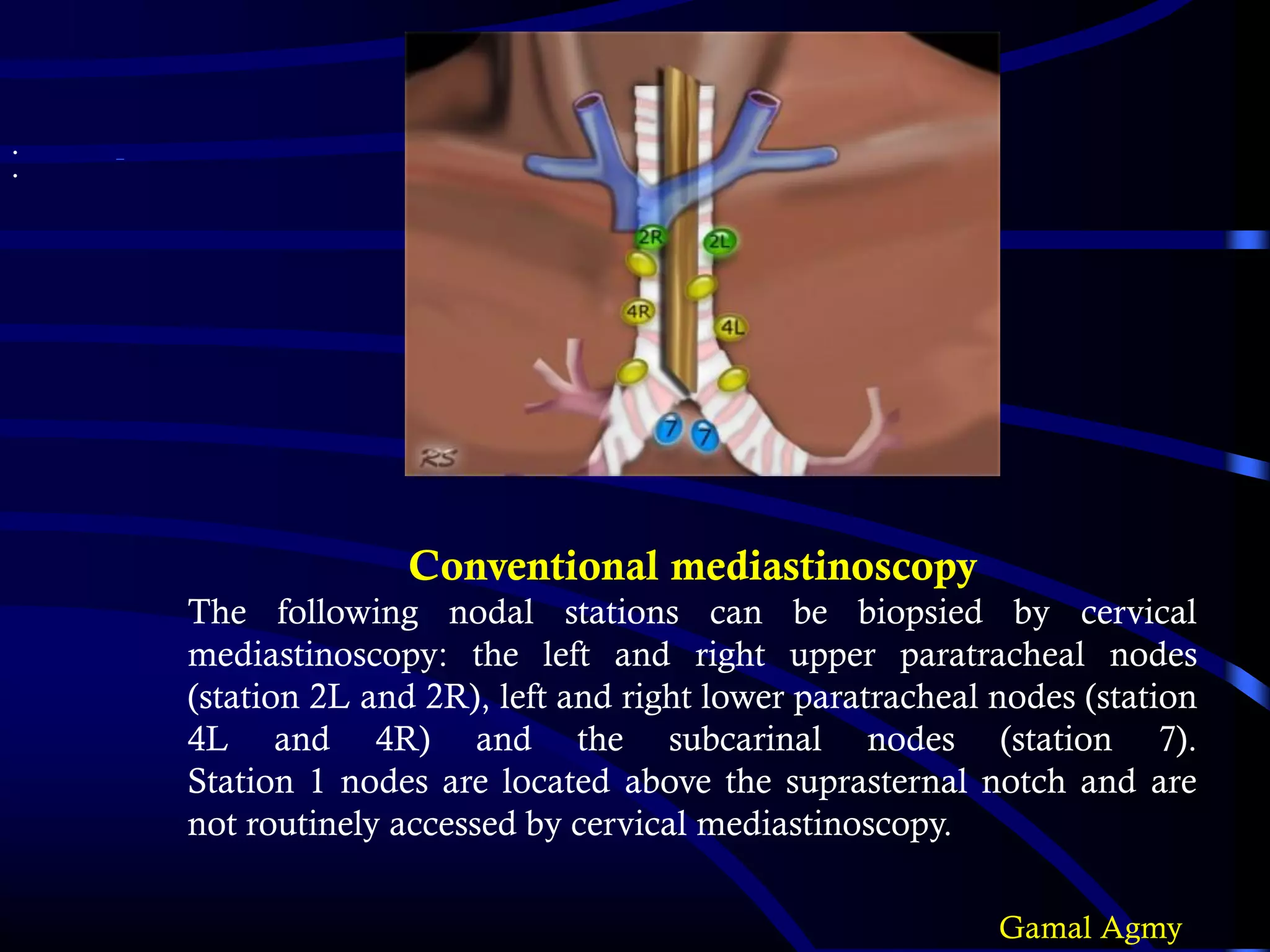 Conventional mediastinoscopy
The following nodal stations can be biopsied by cervical
mediastinoscopy: the left and right upper paratracheal nodes
(station 2L and 2R), left and right lower paratracheal nodes (station
4L and 4R) and the subcarinal nodes (station 7).
Station 1 nodes are located above the suprasternal notch and are
not routinely accessed by cervical mediastinoscopy.
•
•
Gamal Agmy
 