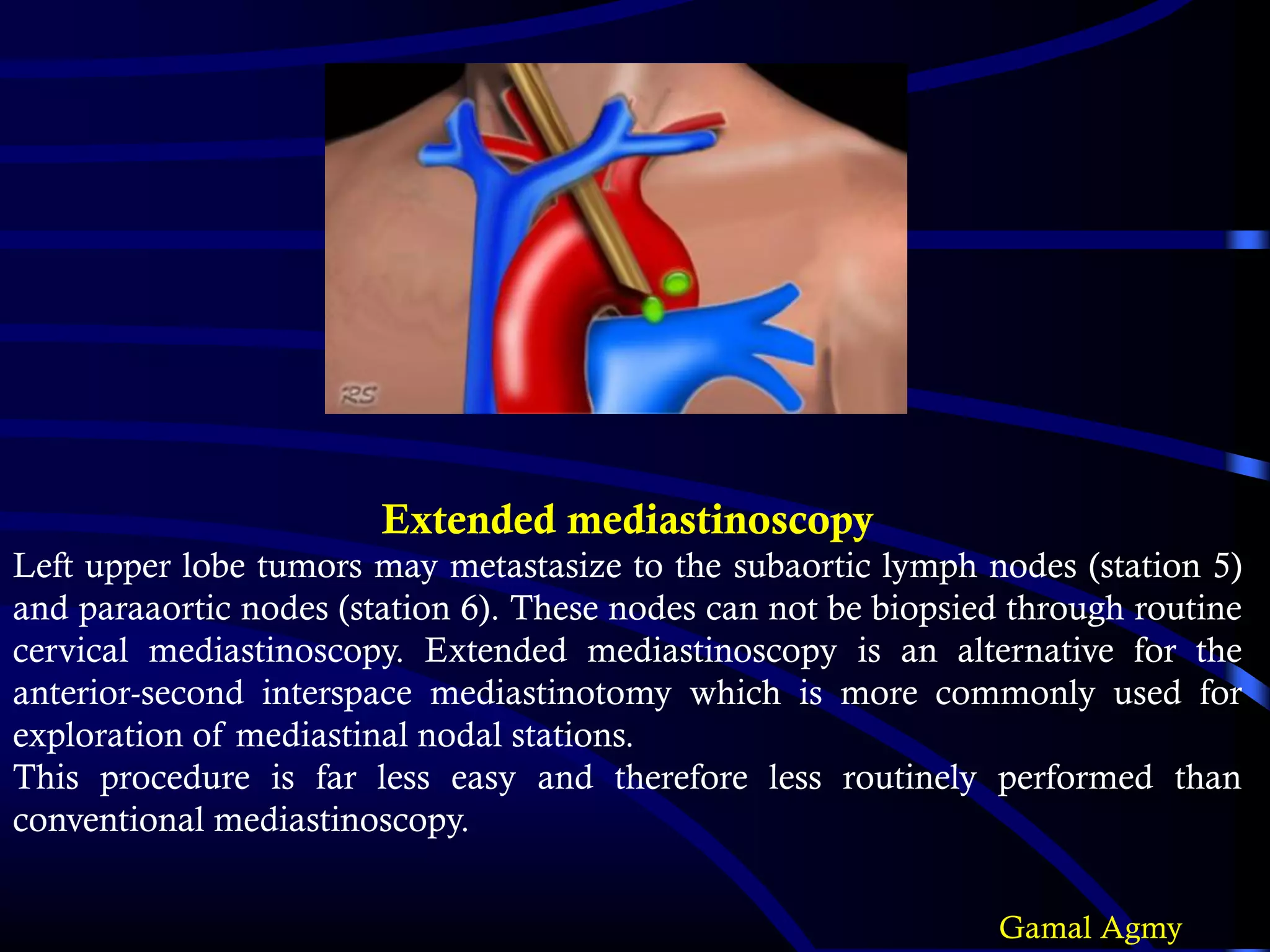 Extended mediastinoscopy
Left upper lobe tumors may metastasize to the subaortic lymph nodes (station 5)
and paraaortic nodes (station 6). These nodes can not be biopsied through routine
cervical mediastinoscopy. Extended mediastinoscopy is an alternative for the
anterior-second interspace mediastinotomy which is more commonly used for
exploration of mediastinal nodal stations.
This procedure is far less easy and therefore less routinely performed than
conventional mediastinoscopy.
Gamal Agmy
 