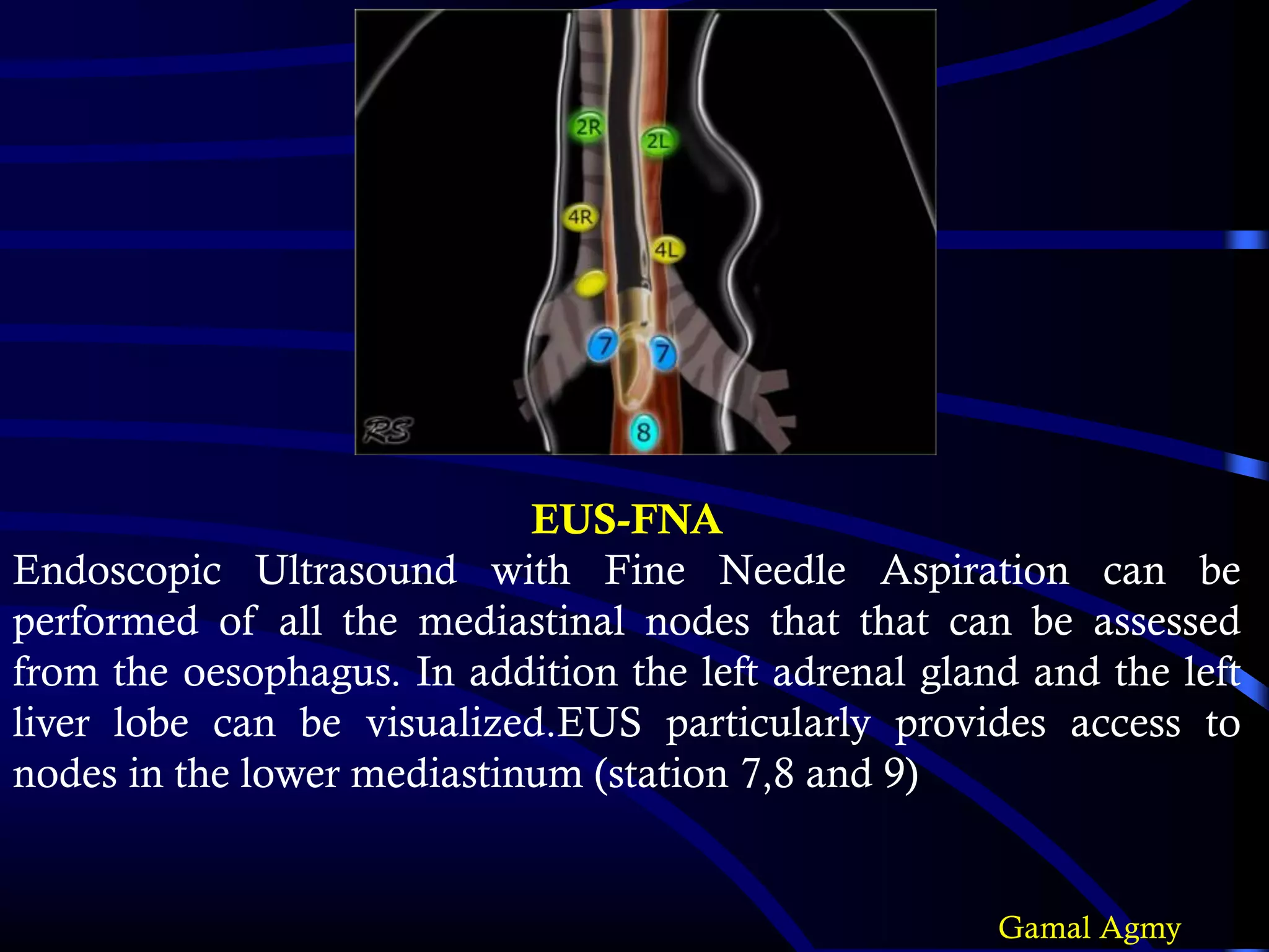 EUS-FNA
Endoscopic Ultrasound with Fine Needle Aspiration can be
performed of all the mediastinal nodes that that can be assessed
from the oesophagus. In addition the left adrenal gland and the left
liver lobe can be visualized.EUS particularly provides access to
nodes in the lower mediastinum (station 7,8 and 9)
Gamal Agmy
 
