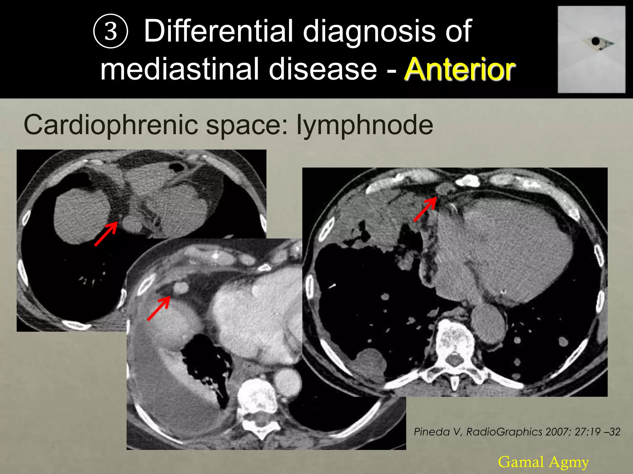 ③ Differential diagnosis of
mediastinal disease - Anterior
Cardiophrenic space: lymphnode
Pineda V, RadioGraphics 2007; 27:19 –32
Gamal Agmy
 