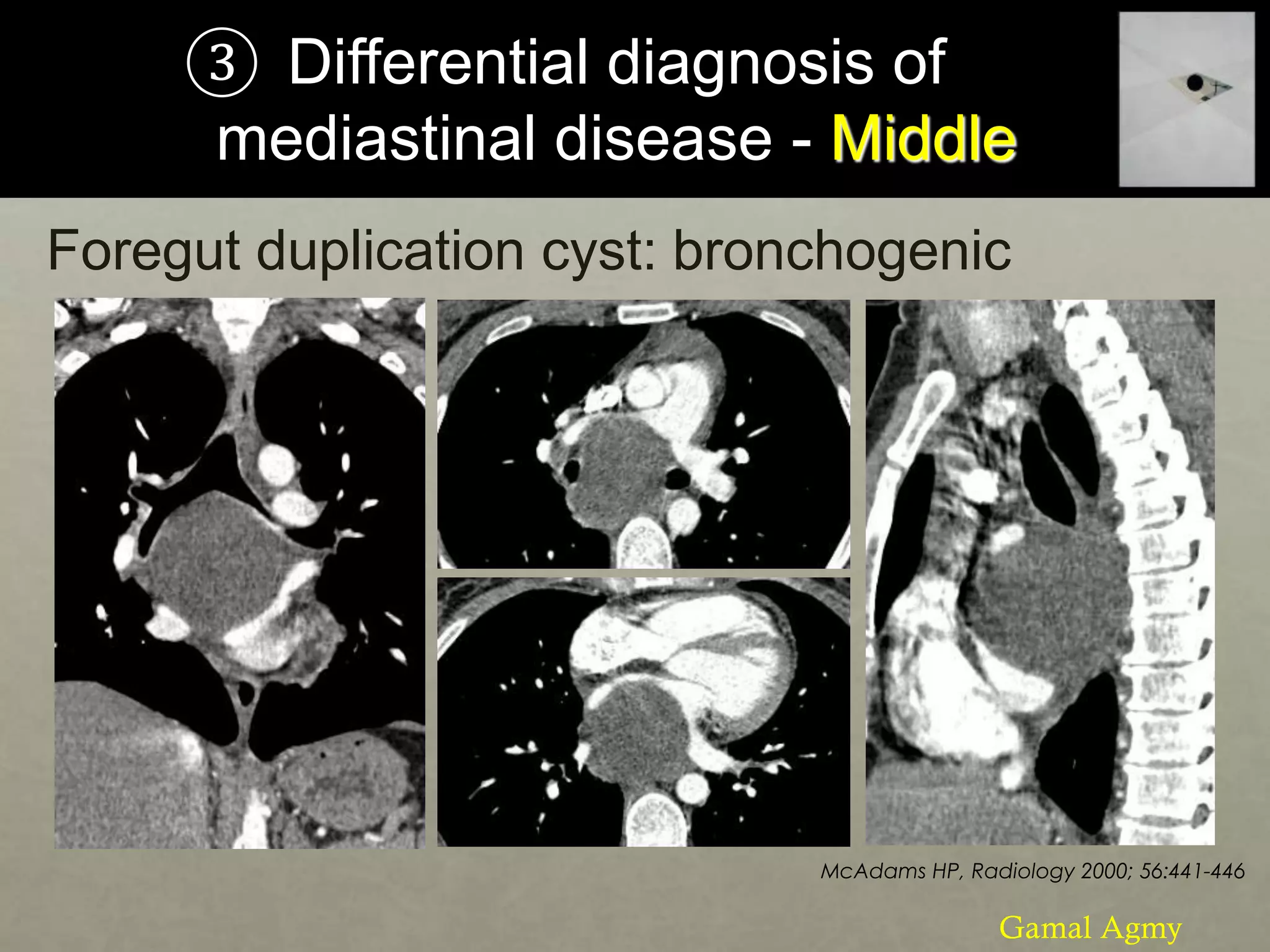 ③ Differential diagnosis of
mediastinal disease - Middle
Foregut duplication cyst: bronchogenic
McAdams HP, Radiology 2000; 56:441-446
Gamal Agmy
 