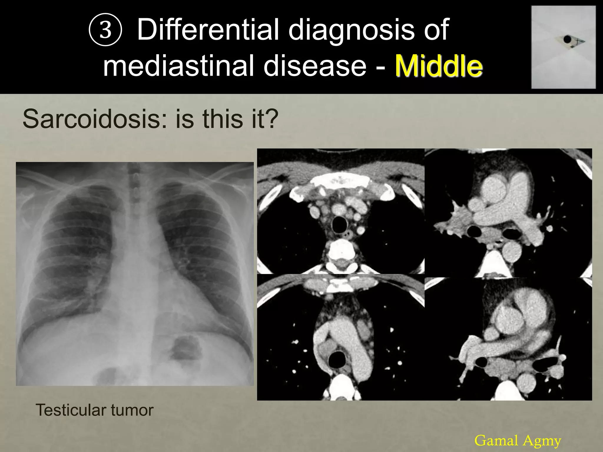 ③ Differential diagnosis of
mediastinal disease - Middle
Sarcoidosis: is this it?
Testicular tumor
Gamal Agmy
 