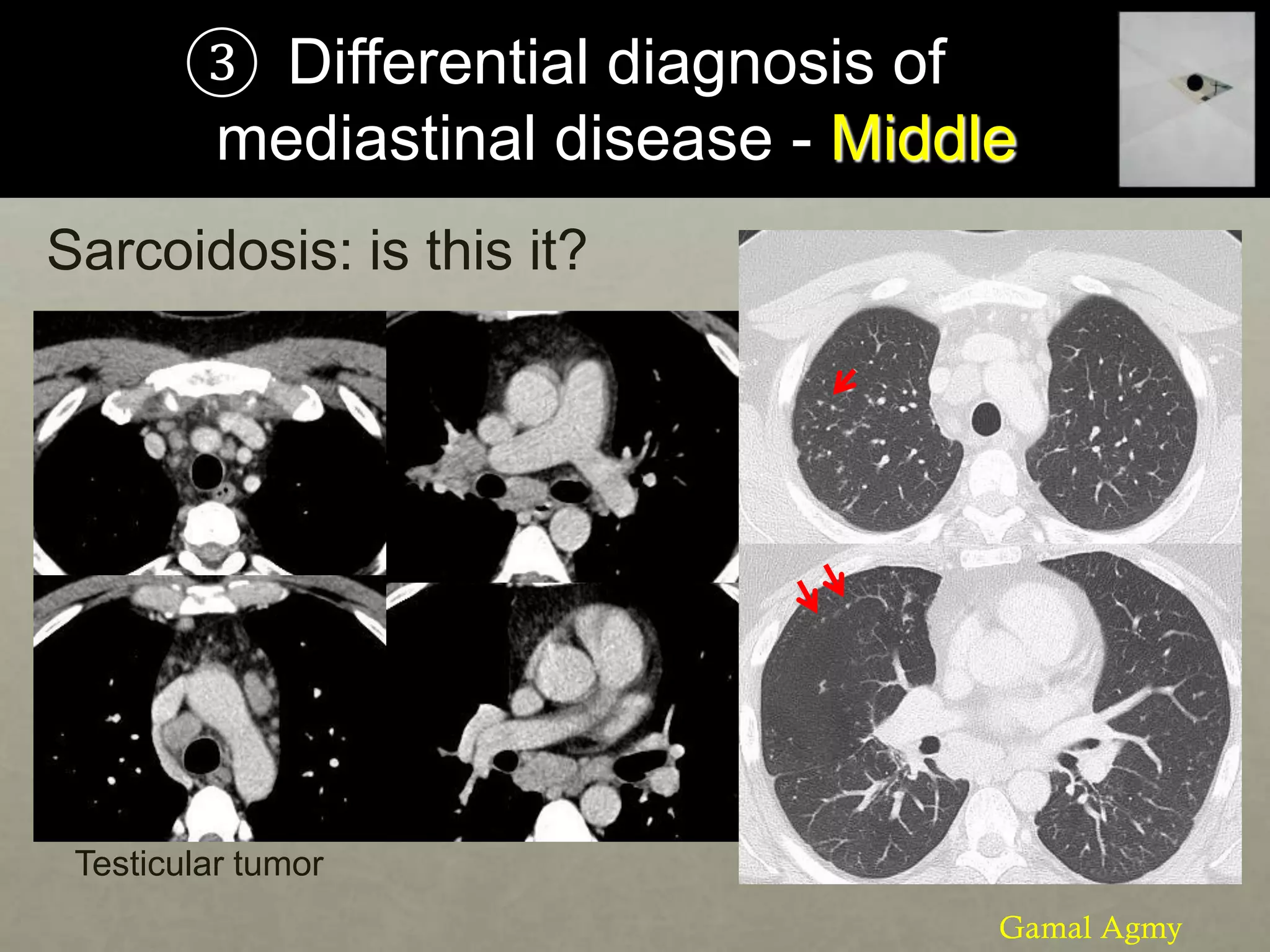 ③ Differential diagnosis of
mediastinal disease - Middle
Sarcoidosis: is this it?
Testicular tumor
Gamal Agmy
 