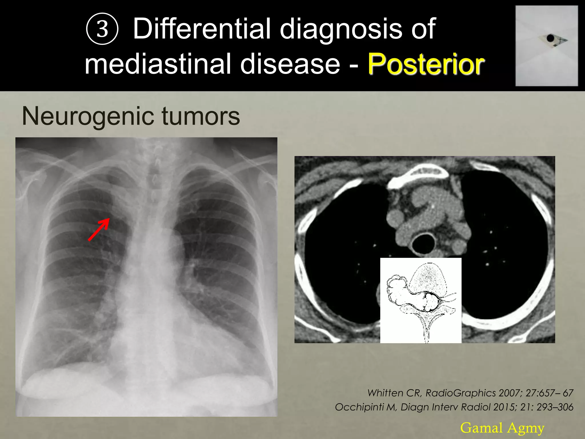 ③ Differential diagnosis of
mediastinal disease - Posterior
Neurogenic tumors
Whitten CR, RadioGraphics 2007; 27:657– 67
Occhipinti M, Diagn Interv Radiol 2015; 21: 293–306
Gamal Agmy
 