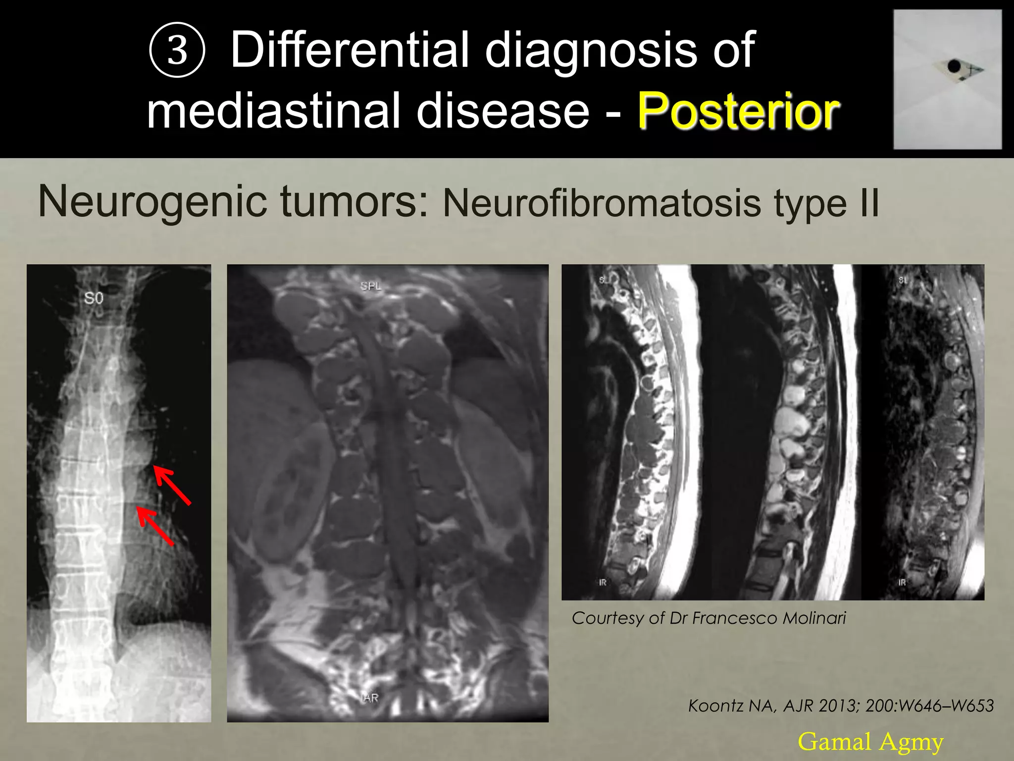 ③ Differential diagnosis of
mediastinal disease - Posterior
Neurogenic tumors: Neurofibromatosis type II
Koontz NA, AJR 2013; 200:W646–W653
Courtesy of Dr Francesco Molinari
Gamal Agmy
 