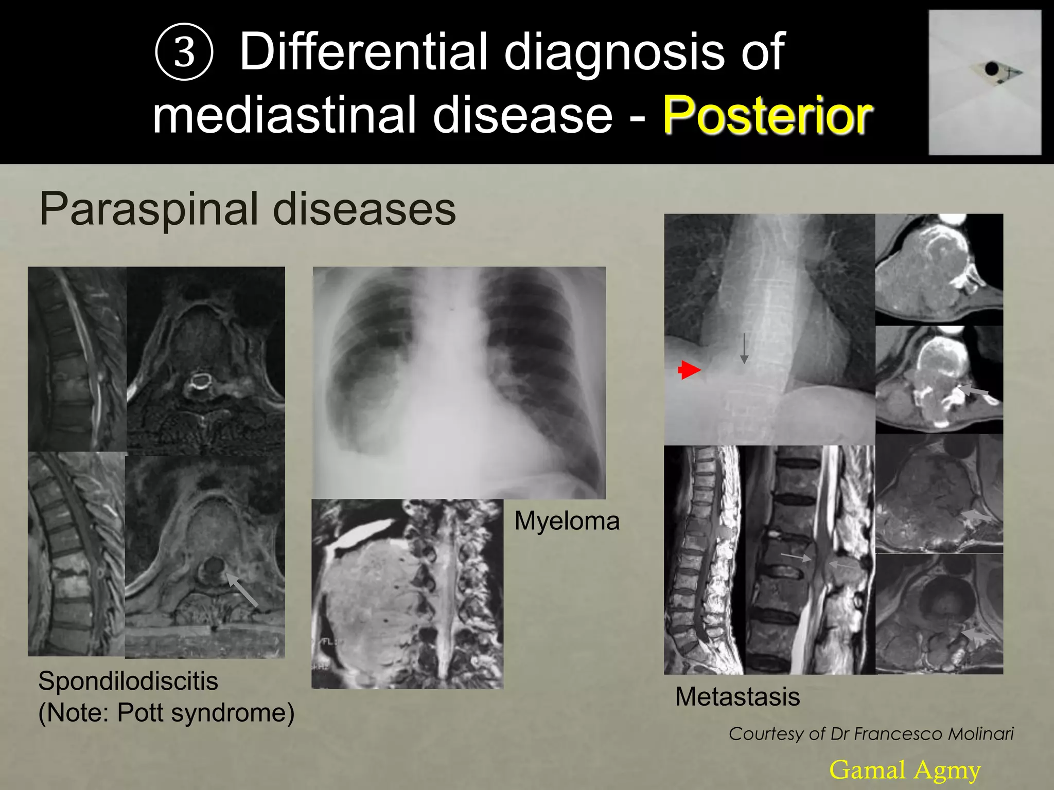 ③ Differential diagnosis of
mediastinal disease - Posterior
Paraspinal diseases
Courtesy of Dr Francesco Molinari
Spondilodiscitis
(Note: Pott syndrome)
Myeloma
Metastasis
Gamal Agmy
 