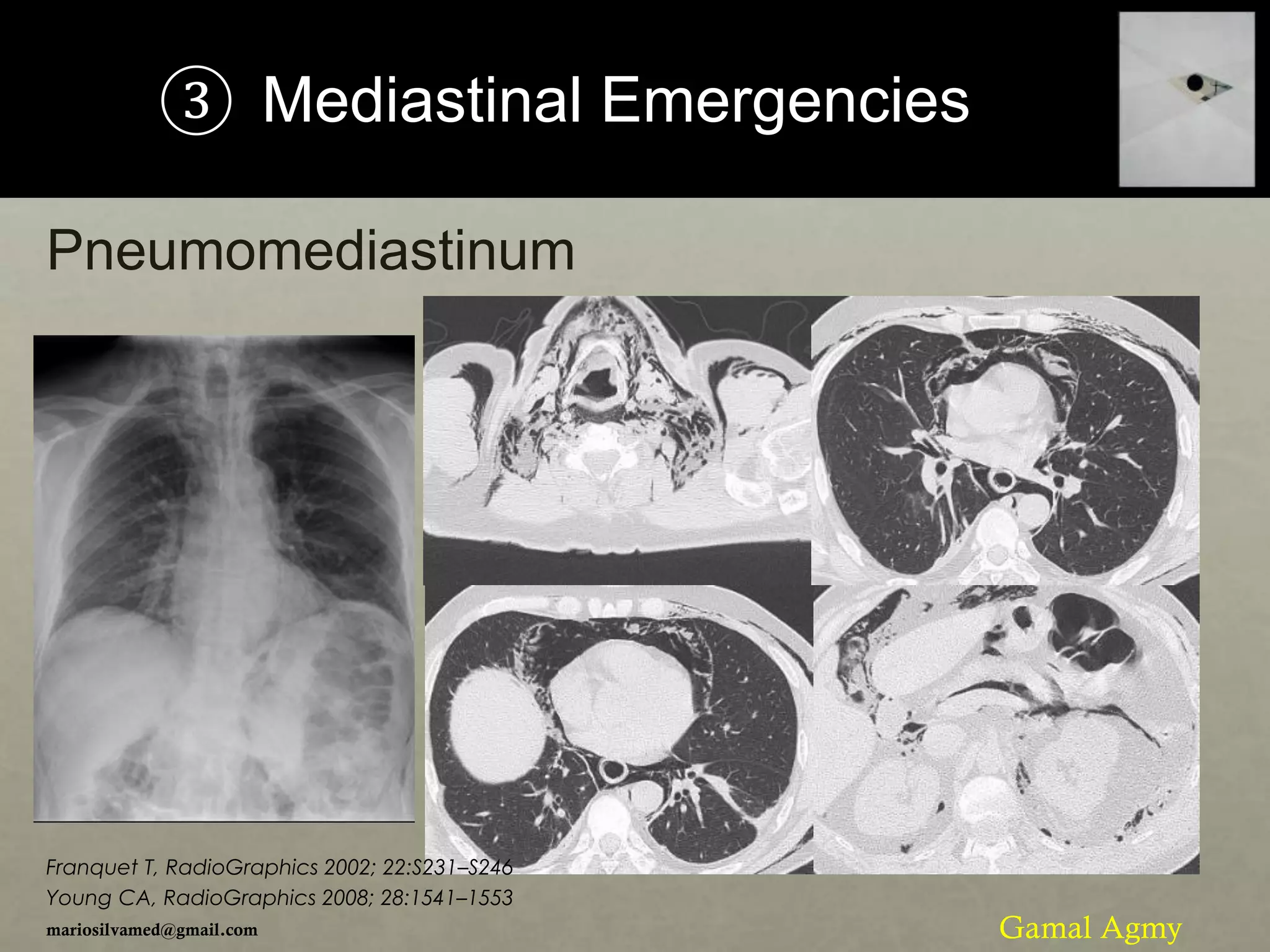 ③ Mediastinal Emergencies
Pneumomediastinum
mariosilvamed@gmail.com
Franquet T, RadioGraphics 2002; 22:S231–S246
Young CA, RadioGraphics 2008; 28:1541–1553
Gamal Agmy
 