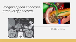 Imaging of non endocrine
tumours of pancreas
DR. DEV LAKHERA
 
