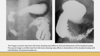 Labels Rao Ugi Imaging of non endocrine tumour of pancreas | PPTX