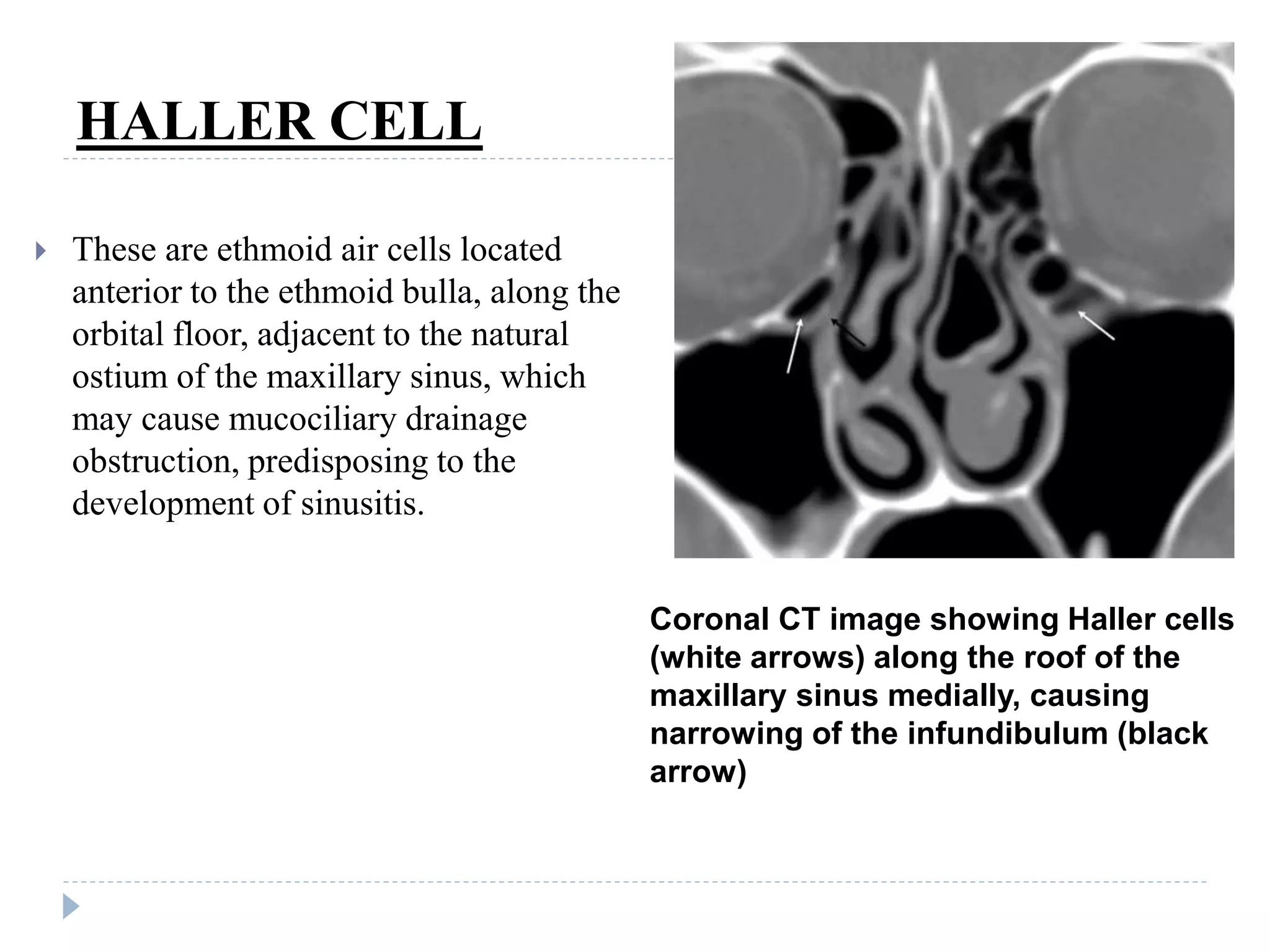 Imaging Of Paranasal Sinuses PPTX Imaging Of Paranasal Sinuses PPTX
