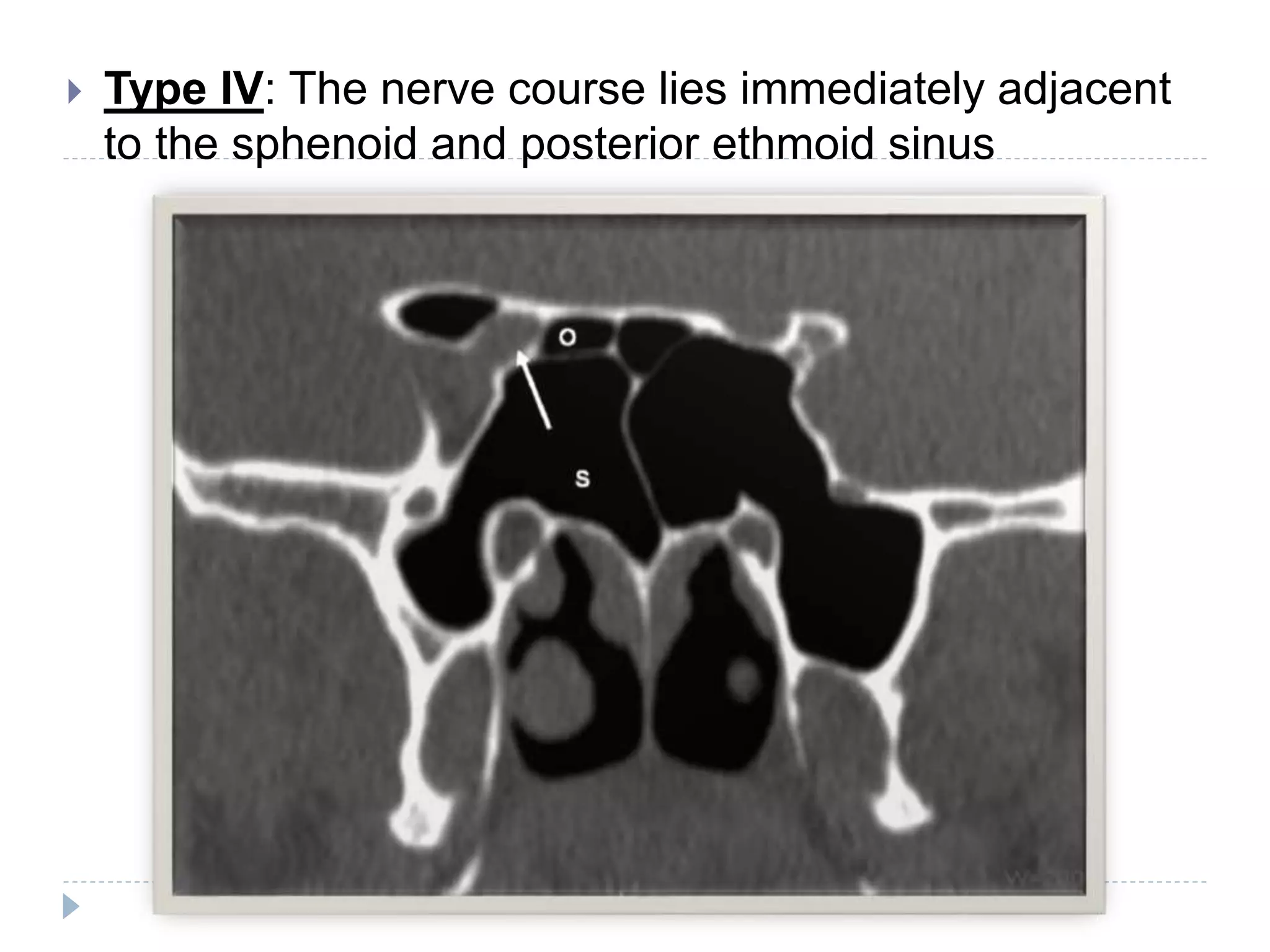  Type IV: The nerve course lies immediately adjacent
to the sphenoid and posterior ethmoid sinus
 