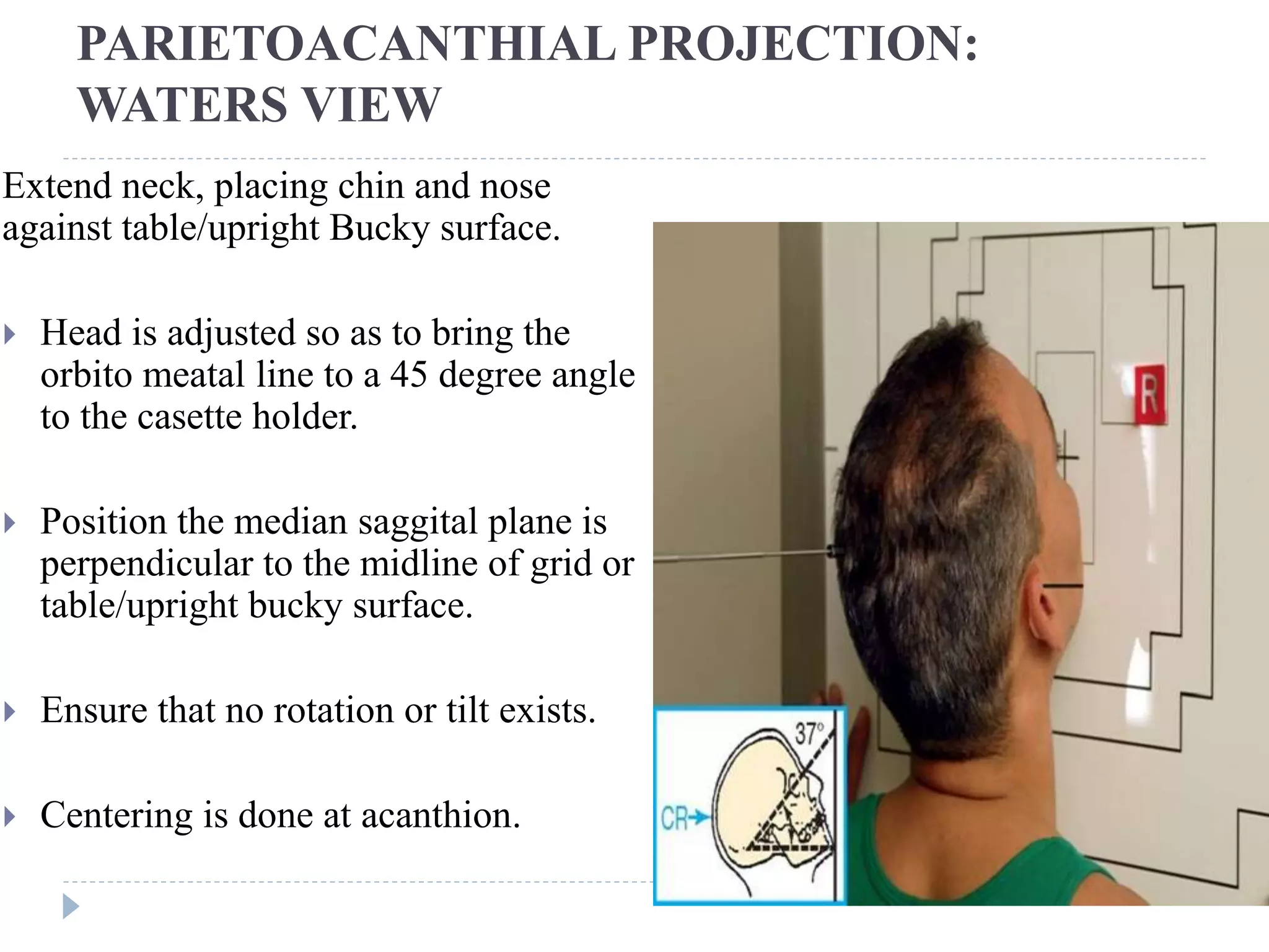 PARIETOACANTHIAL PROJECTION:
WATERS VIEW
Extend neck, placing chin and nose
against table/upright Bucky surface.
 Head is adjusted so as to bring the
orbito meatal line to a 45 degree angle
to the casette holder.
 Position the median saggital plane is
perpendicular to the midline of grid or
table/upright bucky surface.
 Ensure that no rotation or tilt exists.
 Centering is done at acanthion.
 