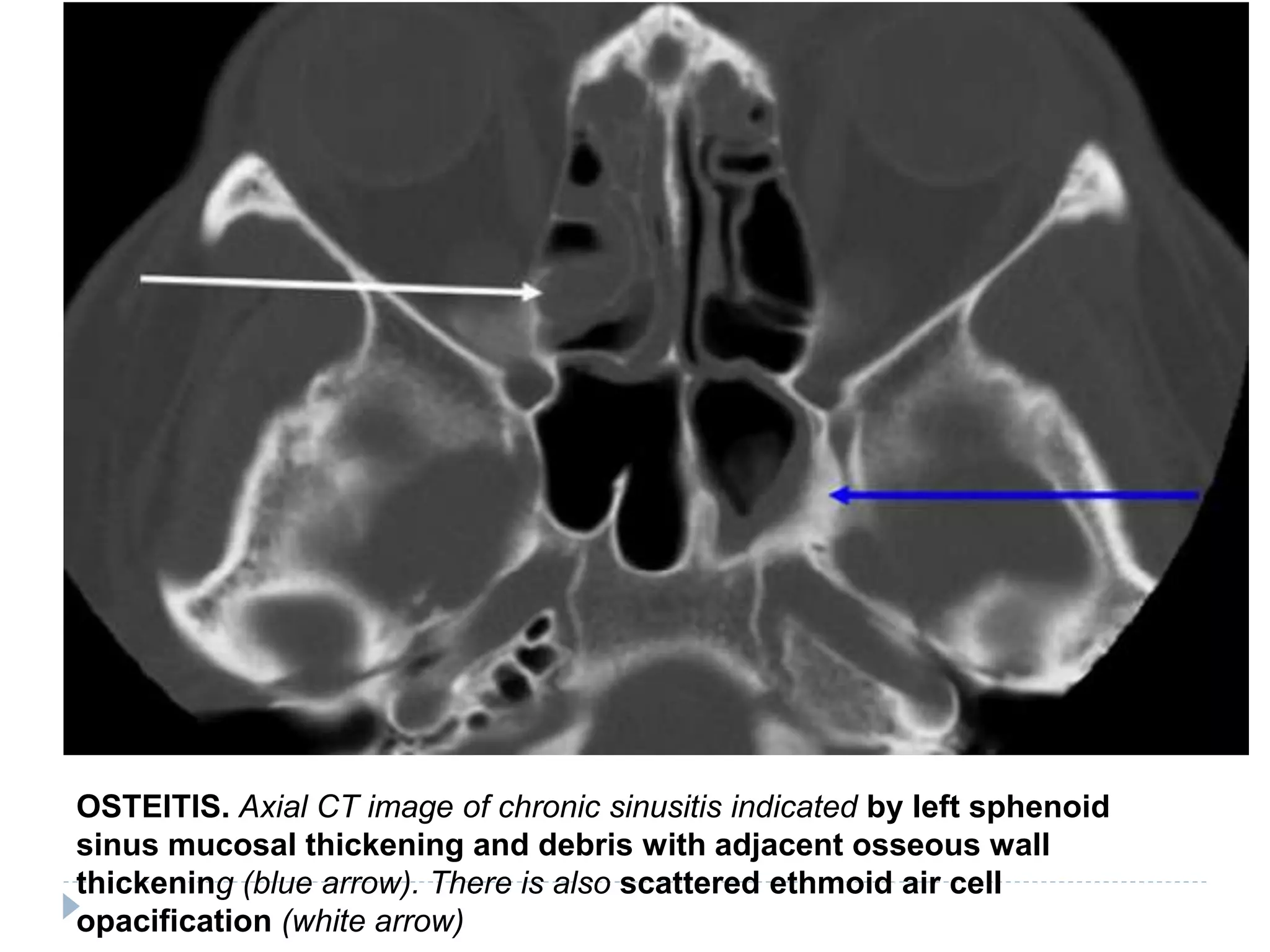OSTEITIS. Axial CT image of chronic sinusitis indicated by left sphenoid
sinus mucosal thickening and debris with adjacent osseous wall
thickening (blue arrow). There is also scattered ethmoid air cell
opacification (white arrow)
 