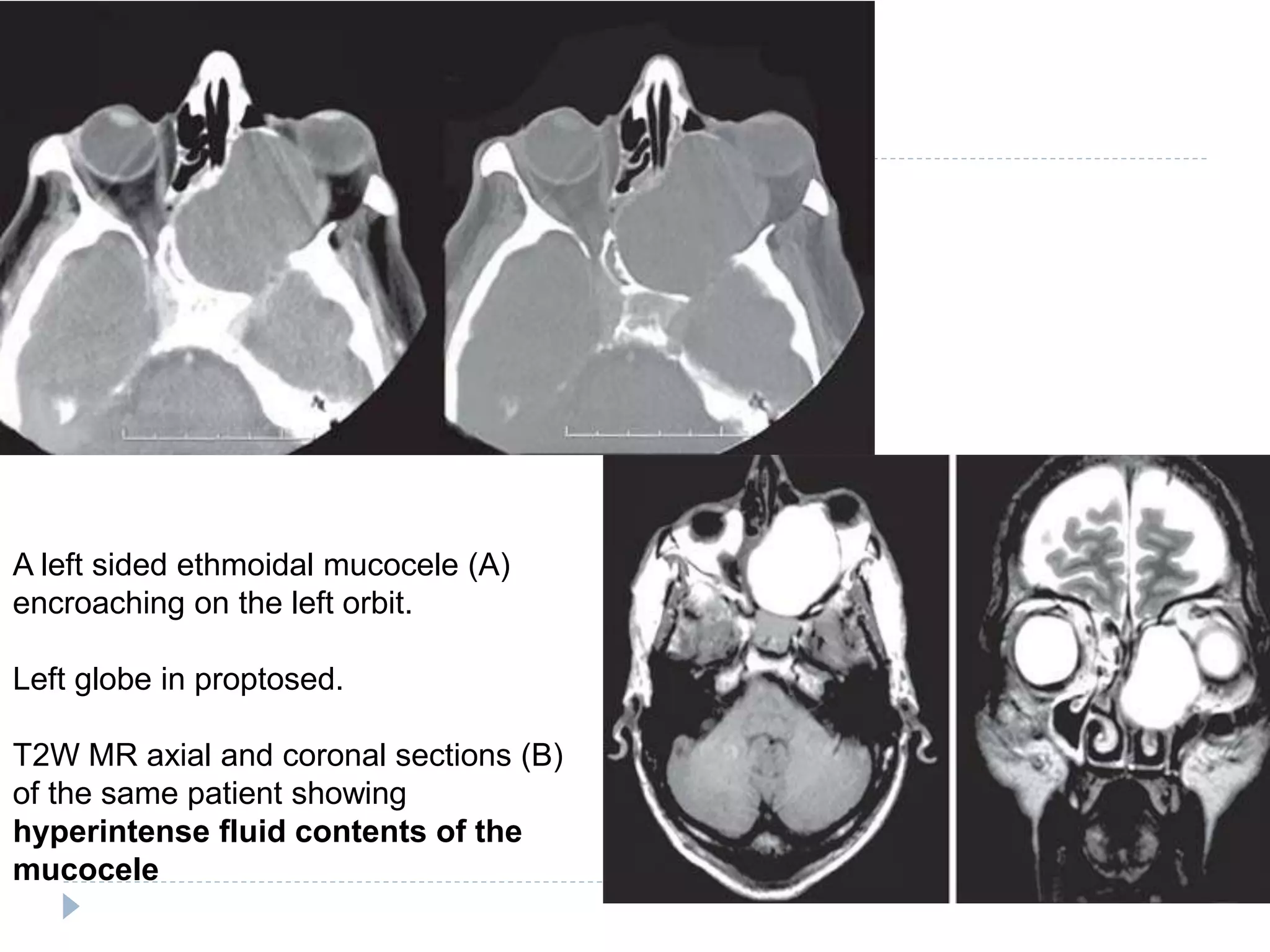A left sided ethmoidal mucocele (A)
encroaching on the left orbit.
Left globe in proptosed.
T2W MR axial and coronal sections (B)
of the same patient showing
hyperintense fluid contents of the
mucocele
 