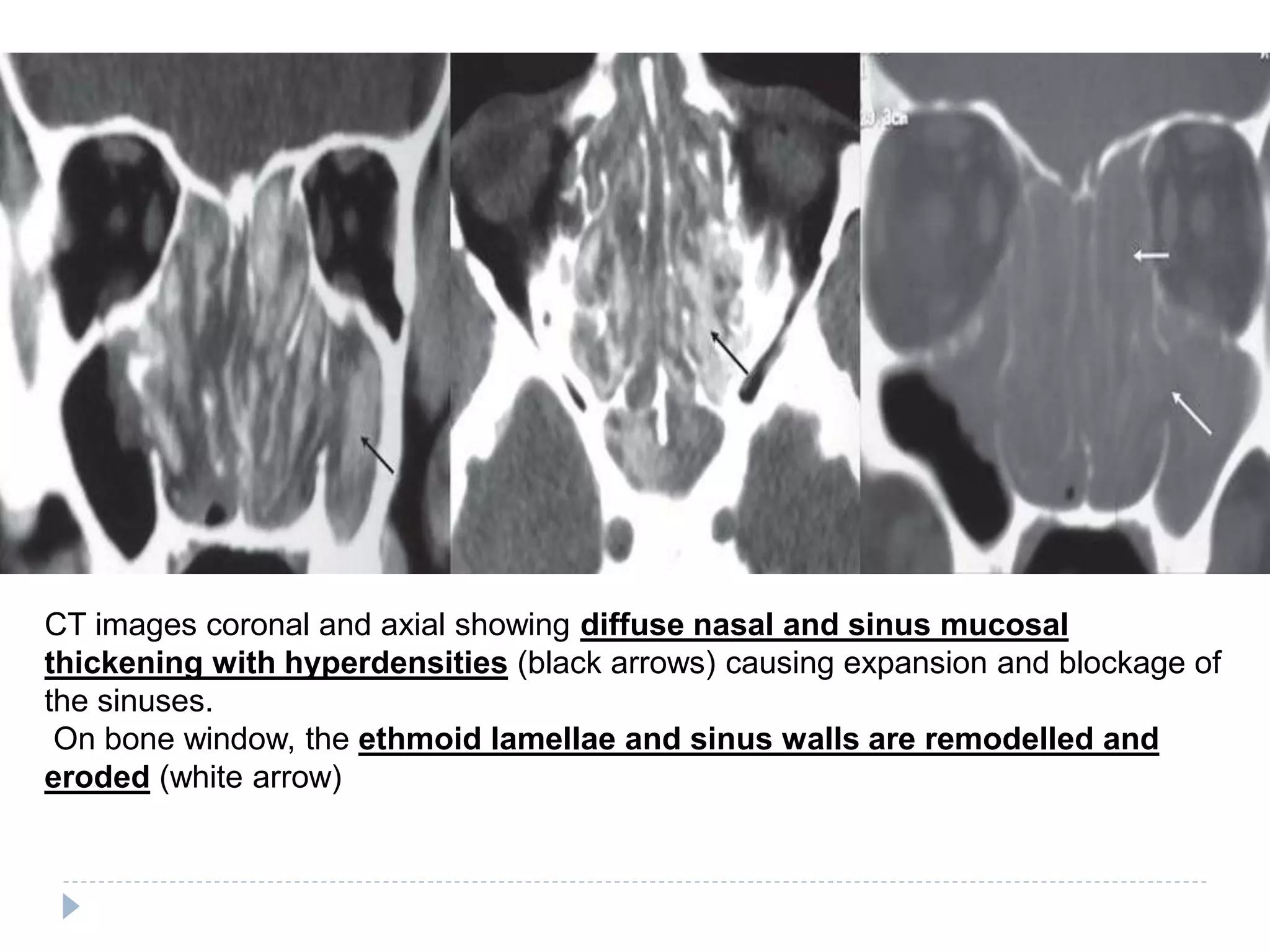 CT images coronal and axial showing diffuse nasal and sinus mucosal
thickening with hyperdensities (black arrows) causing expansion and blockage of
the sinuses.
On bone window, the ethmoid lamellae and sinus walls are remodelled and
eroded (white arrow)
 