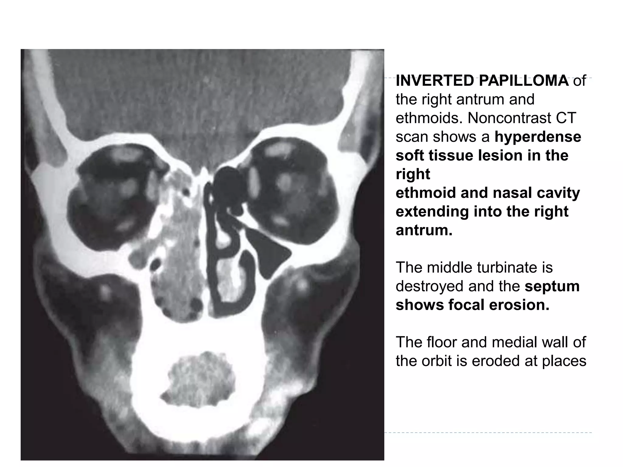 INVERTED PAPILLOMA of
the right antrum and
ethmoids. Noncontrast CT
scan shows a hyperdense
soft tissue lesion in the
right
ethmoid and nasal cavity
extending into the right
antrum.
The middle turbinate is
destroyed and the septum
shows focal erosion.
The floor and medial wall of
the orbit is eroded at places
 