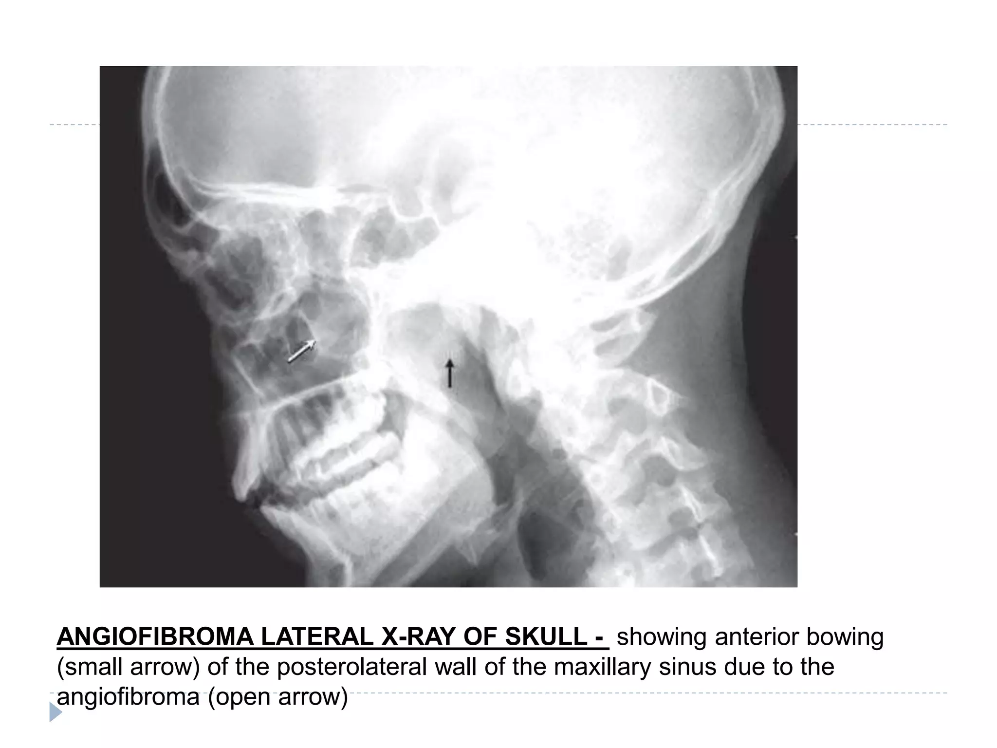 ANGIOFIBROMA LATERAL X-RAY OF SKULL - showing anterior bowing
(small arrow) of the posterolateral wall of the maxillary sinus due to the
angiofibroma (open arrow)
 