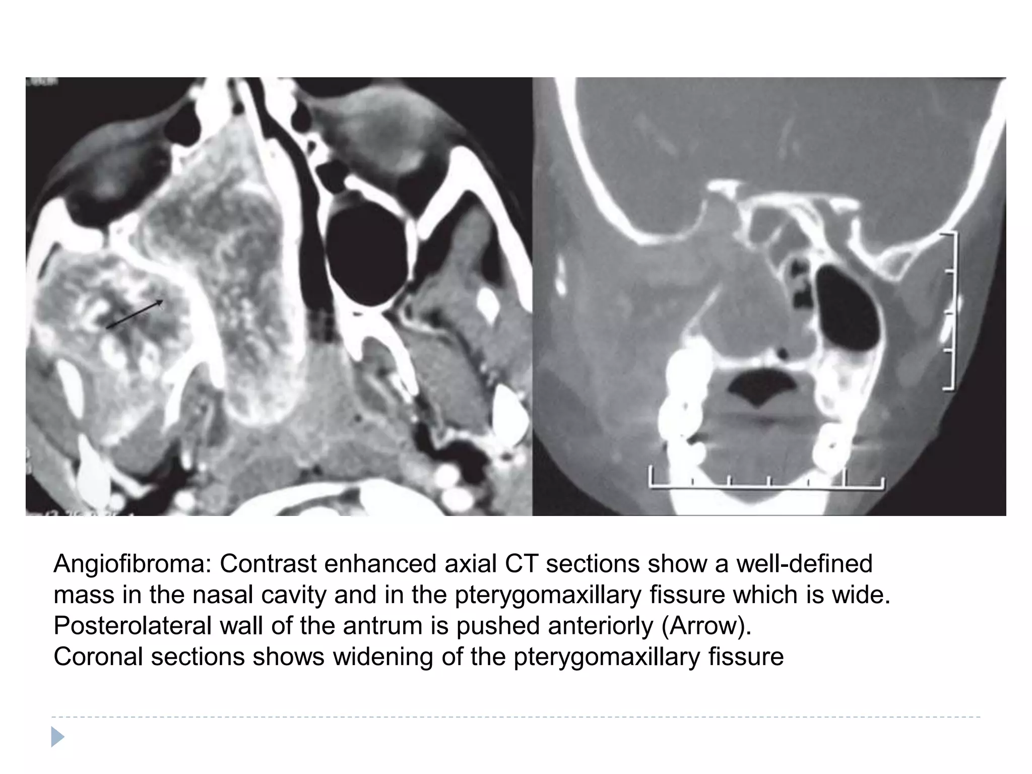 Angiofibroma: Contrast enhanced axial CT sections show a well-defined
mass in the nasal cavity and in the pterygomaxillary fissure which is wide.
Posterolateral wall of the antrum is pushed anteriorly (Arrow).
Coronal sections shows widening of the pterygomaxillary fissure
 