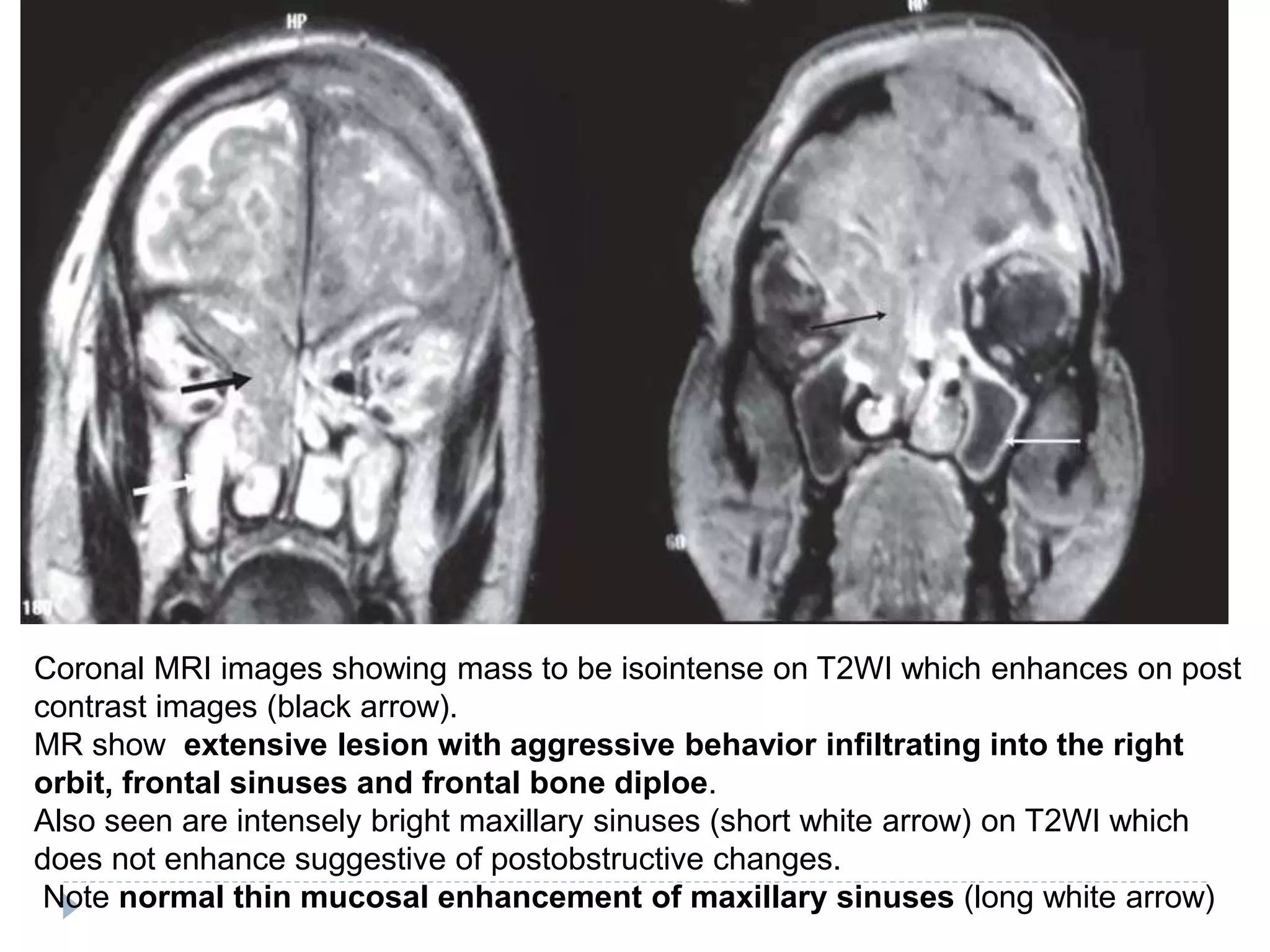 Coronal MRI images showing mass to be isointense on T2WI which enhances on post
contrast images (black arrow).
MR show extensive lesion with aggressive behavior infiltrating into the right
orbit, frontal sinuses and frontal bone diploe.
Also seen are intensely bright maxillary sinuses (short white arrow) on T2WI which
does not enhance suggestive of postobstructive changes.
Note normal thin mucosal enhancement of maxillary sinuses (long white arrow)
 