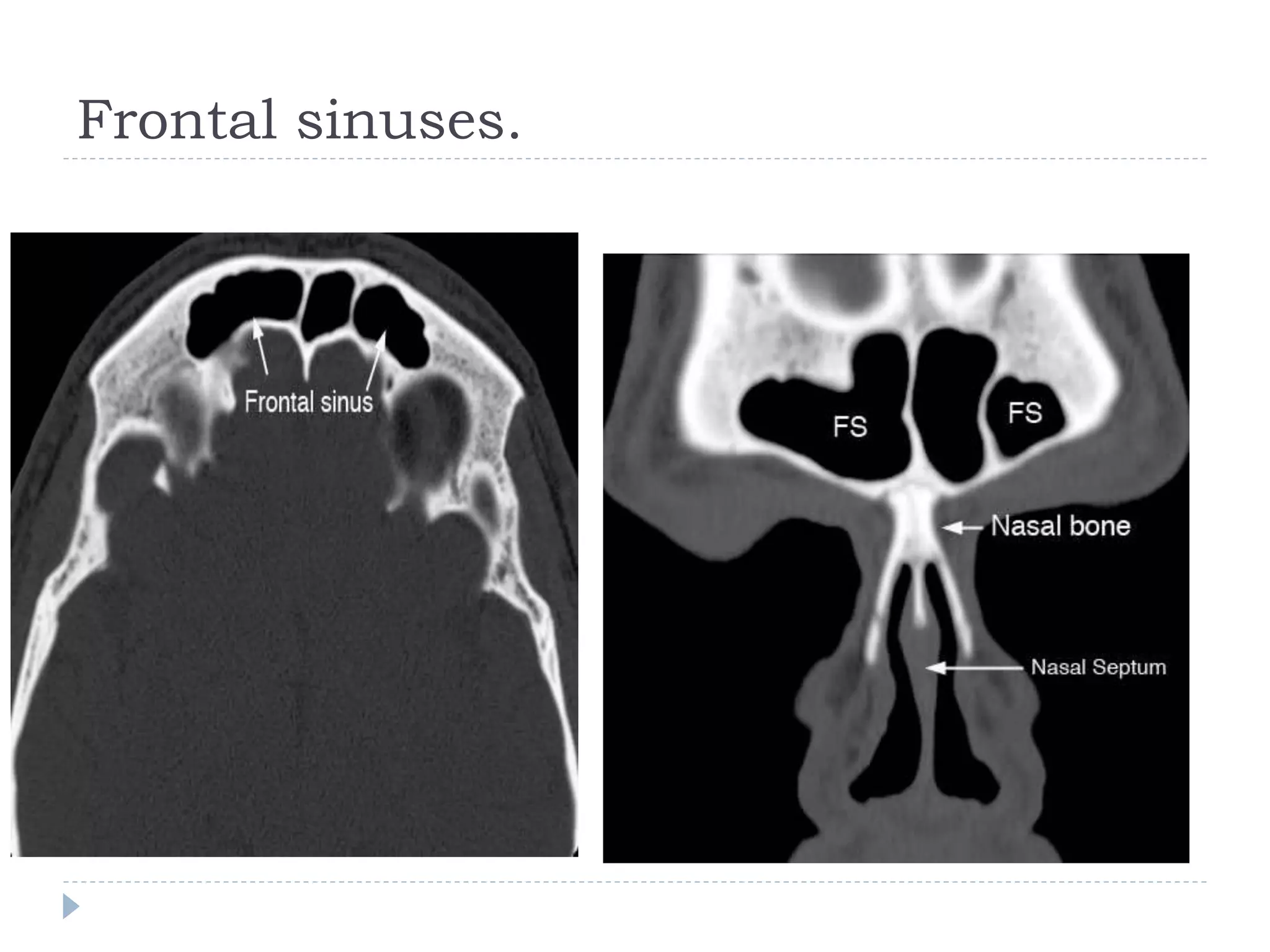Frontal sinuses.
 