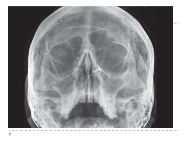 Paranasal Sinuses And Facial Bones Radiography Radiology Reference