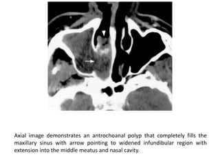 IMAGING OF PARANASAL SINUSES.ppt