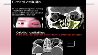 Imaging of paranasal sinuses (including anatomy and varaints)pk1 pdf  ppt