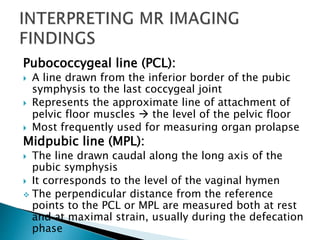 Pcl Line Imaging of pelvic floor weakness | PPTX