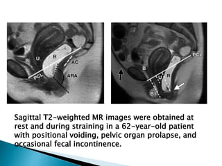 Positional Incontinance Imaging of pelvic floor weakness | PPTX