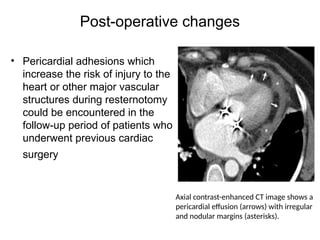 Bedside Resternotomy Radiological maging of various pericardial pathologies | PPTX