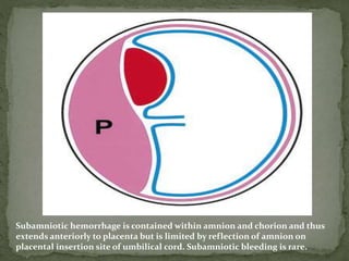  Placenta accreta : chorionic villi attach to myometrium
(more than 1/3rd ), rather than being restricted within
the deci...