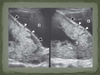 Imaging of placenta