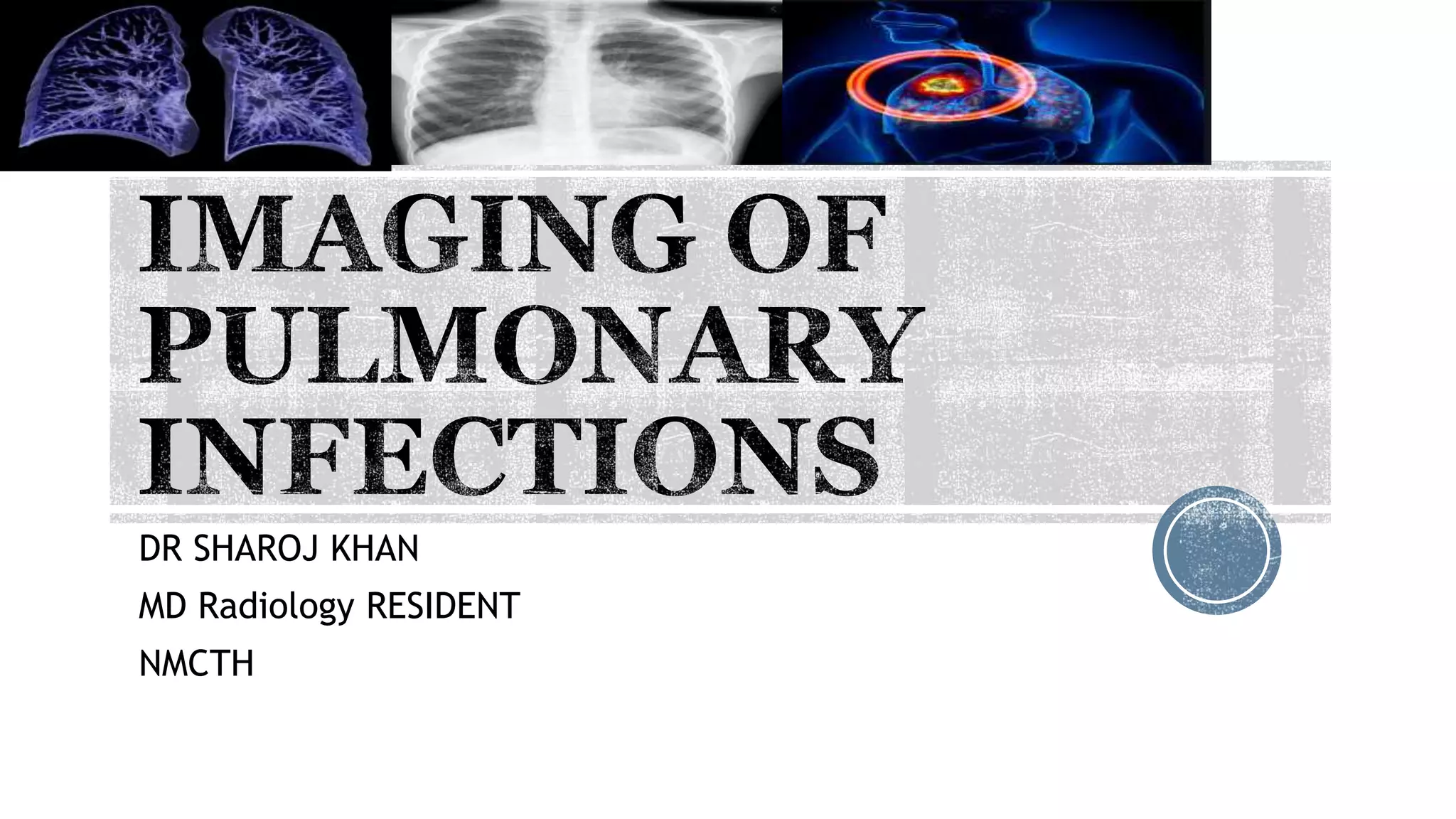 Imaging of pulmonary infections | PPTX