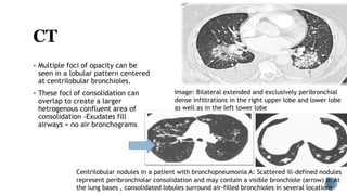 Imaging of pulmonary infections | PPTX