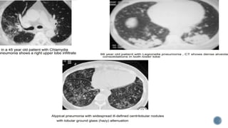 Imaging of pulmonary infections | PPTX
